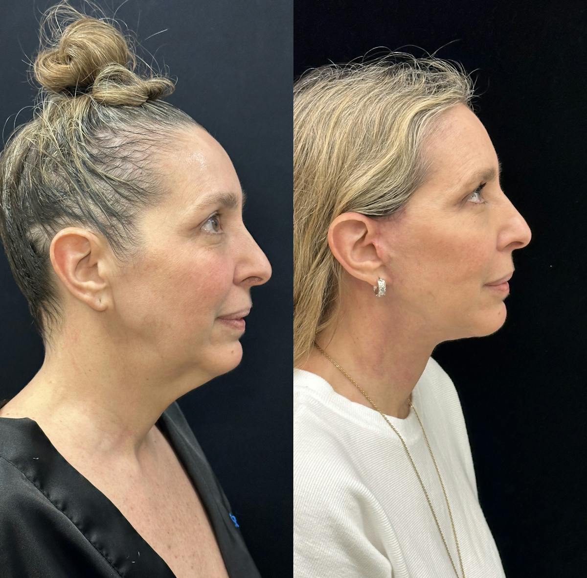 Deep Plane Facelift Before & After Gallery - Patient 829775 - Image 2