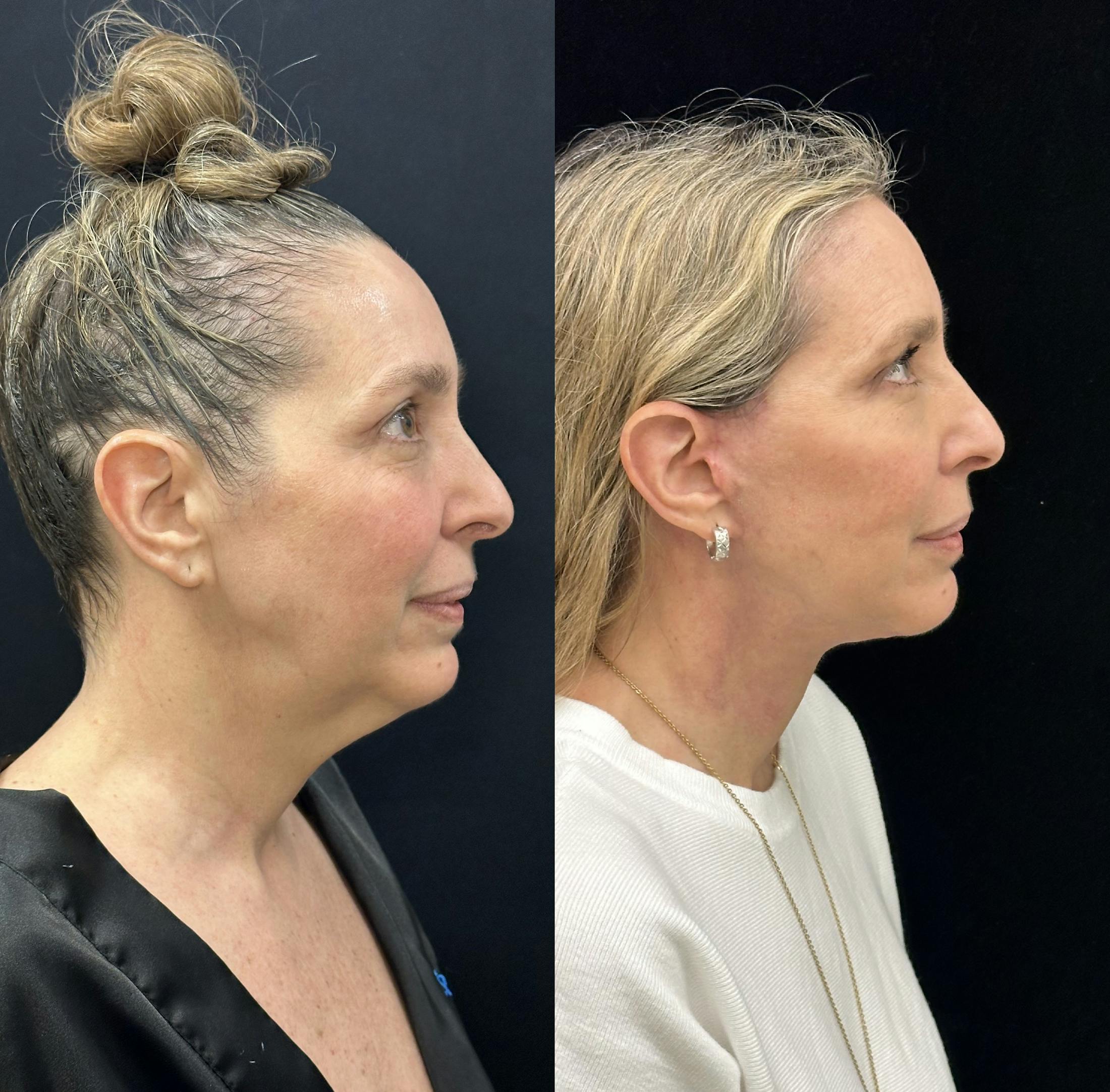 Deep Plane Facelift Before & After Gallery - Patient 829775 - Image 2