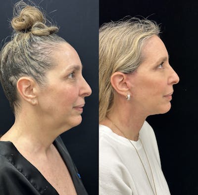 Deep Plane Facelift Before & After Gallery - Patient 829775 - Image 2