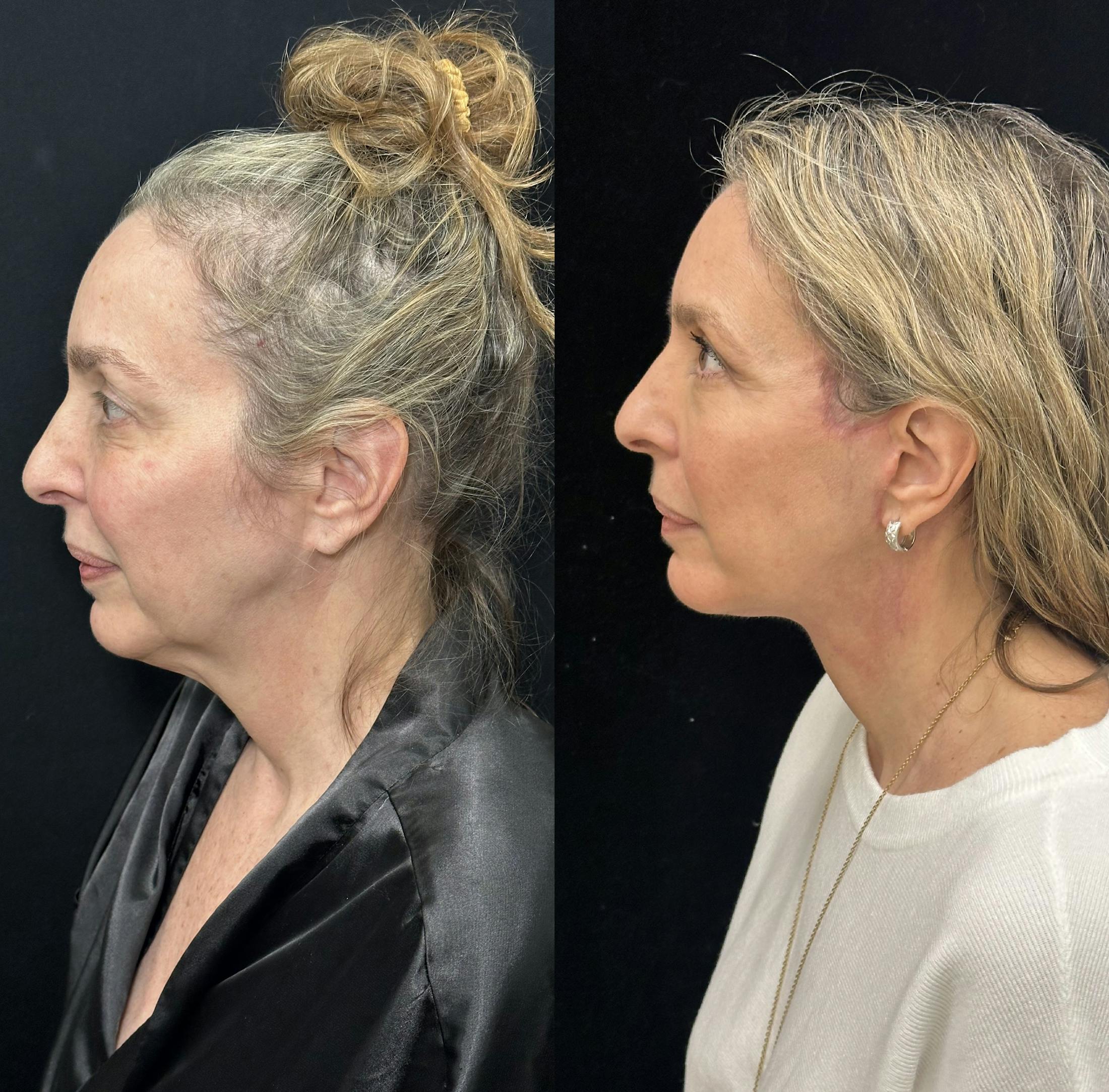 Deep Plane Facelift Before & After Gallery - Patient 829775 - Image 4