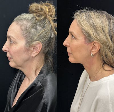 Deep Plane Facelift Before & After Gallery - Patient 829775 - Image 4