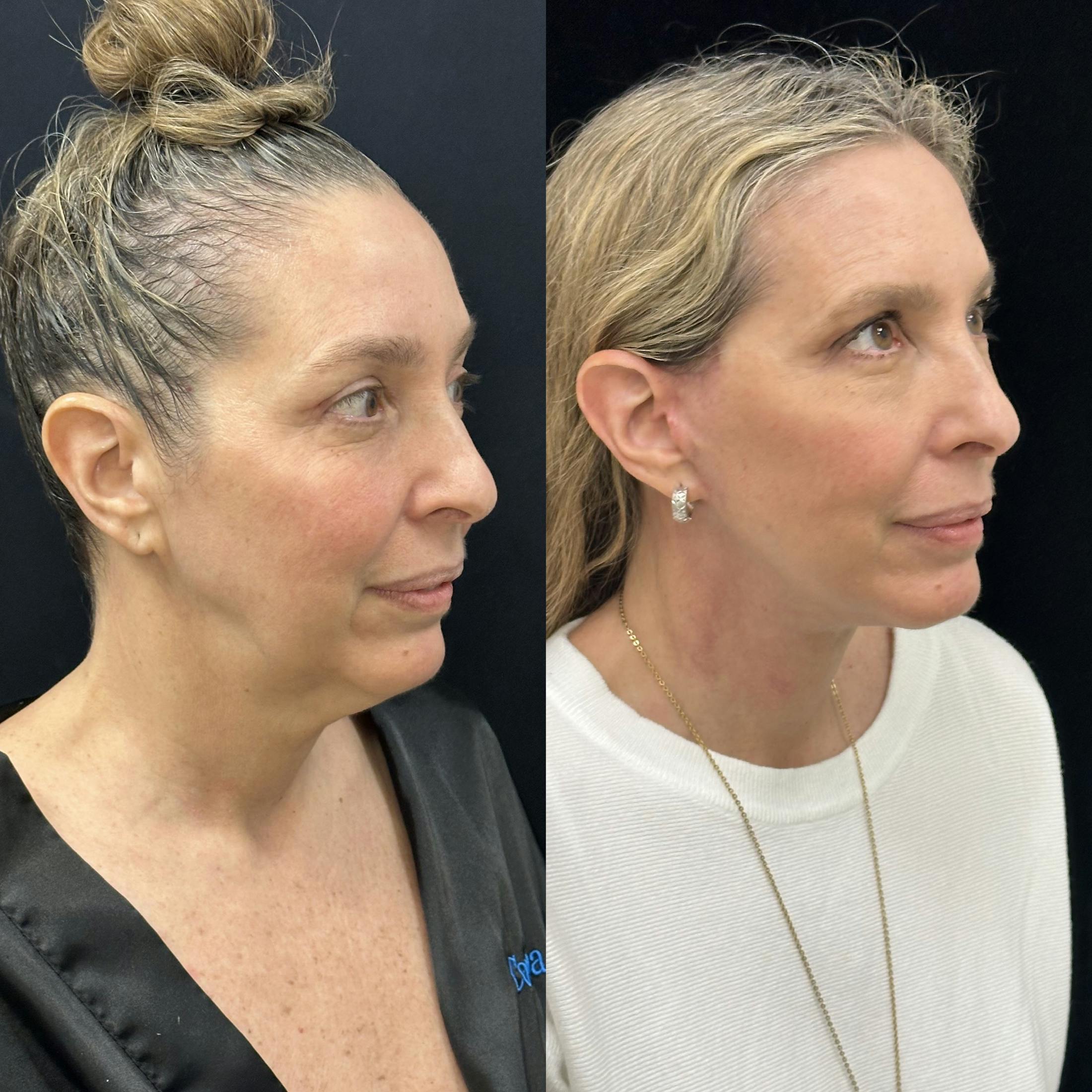 Deep Plane Facelift Before & After Gallery - Patient 829775 - Image 1