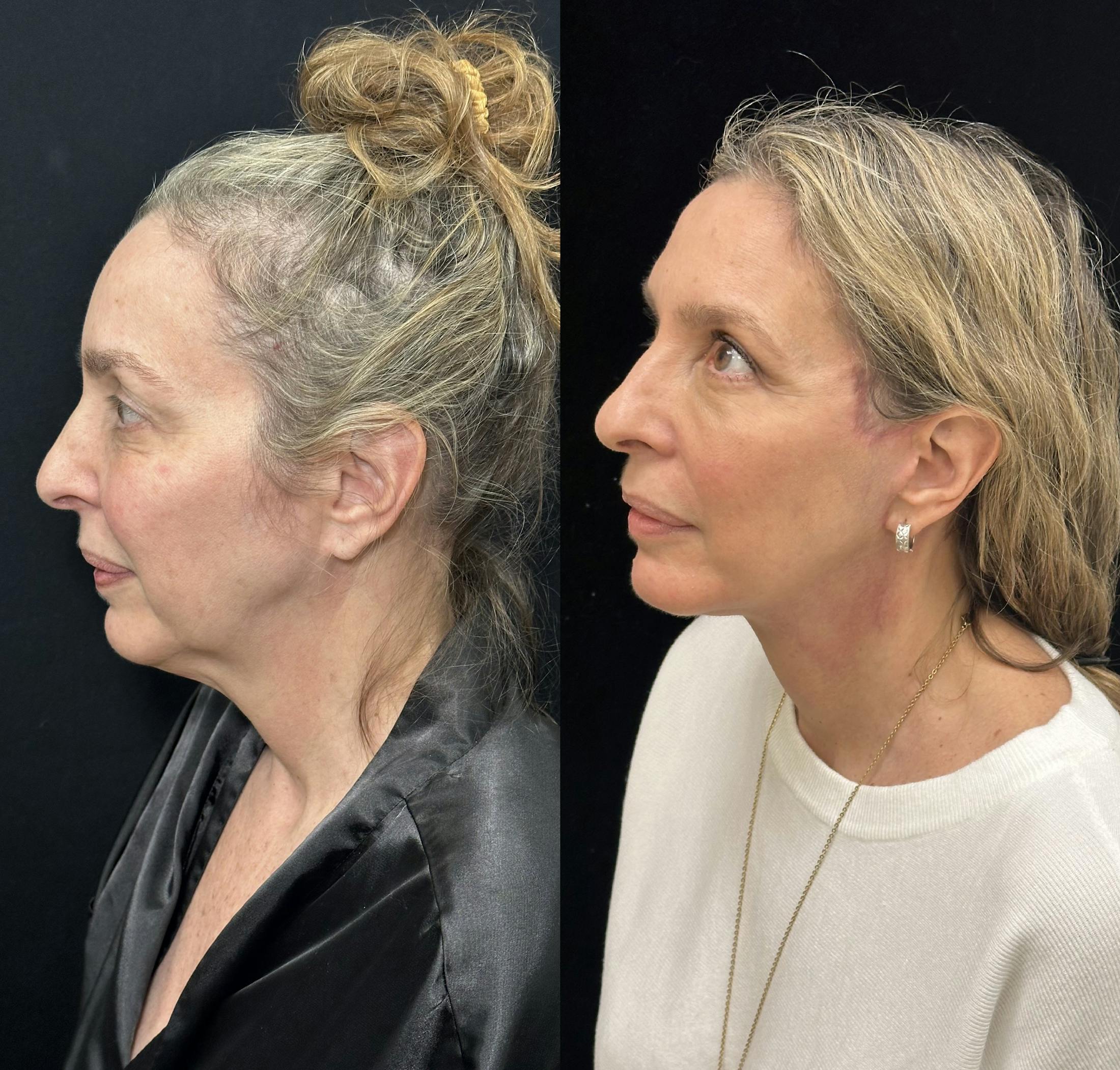 Deep Plane Facelift Before & After Gallery - Patient 829775 - Image 3