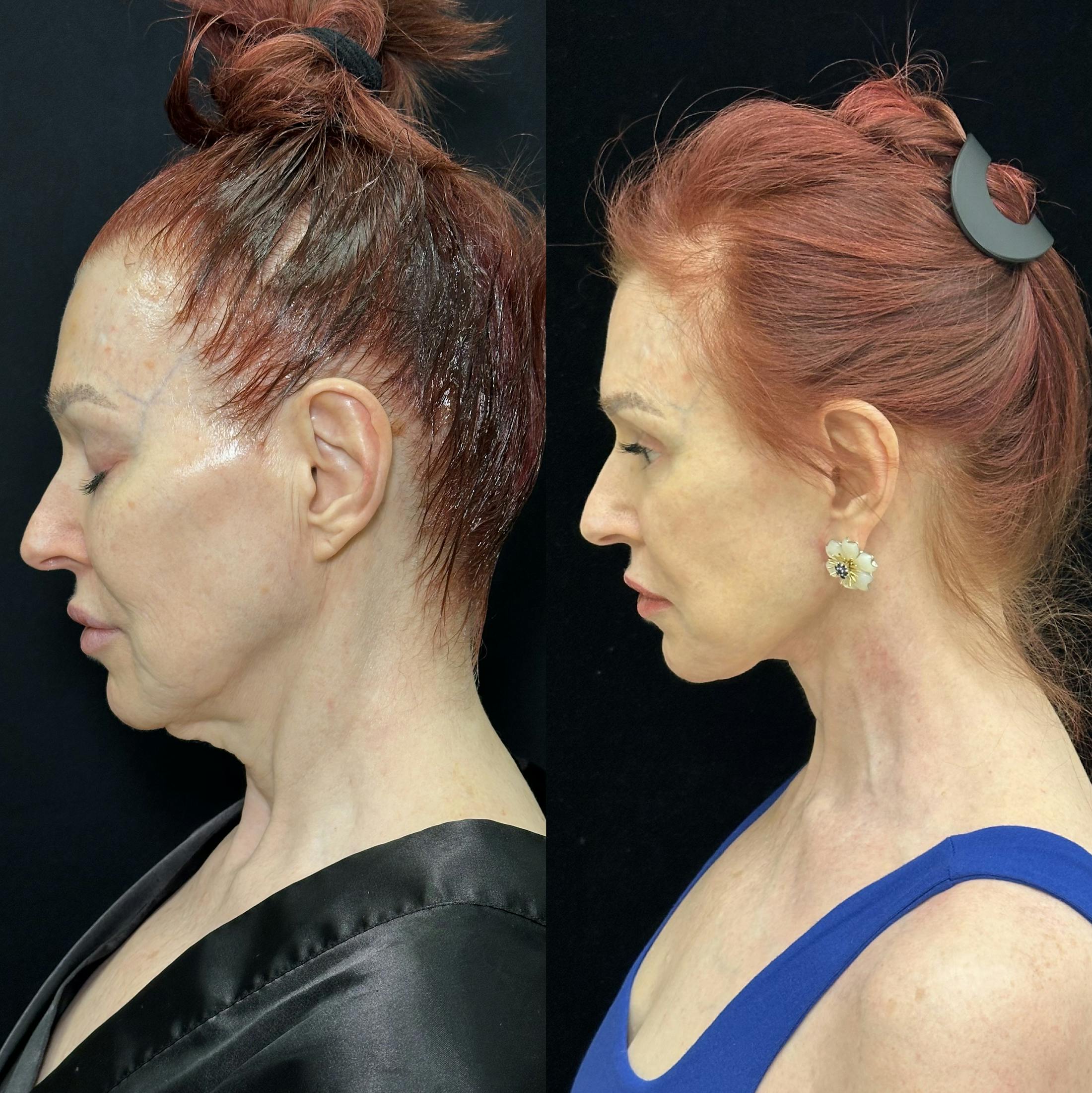 Deep Plane Facelift Before & After Gallery - Patient 123229 - Image 7