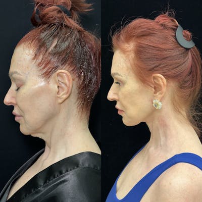 Deep Plane Facelift Before & After Gallery - Patient 123229 - Image 7