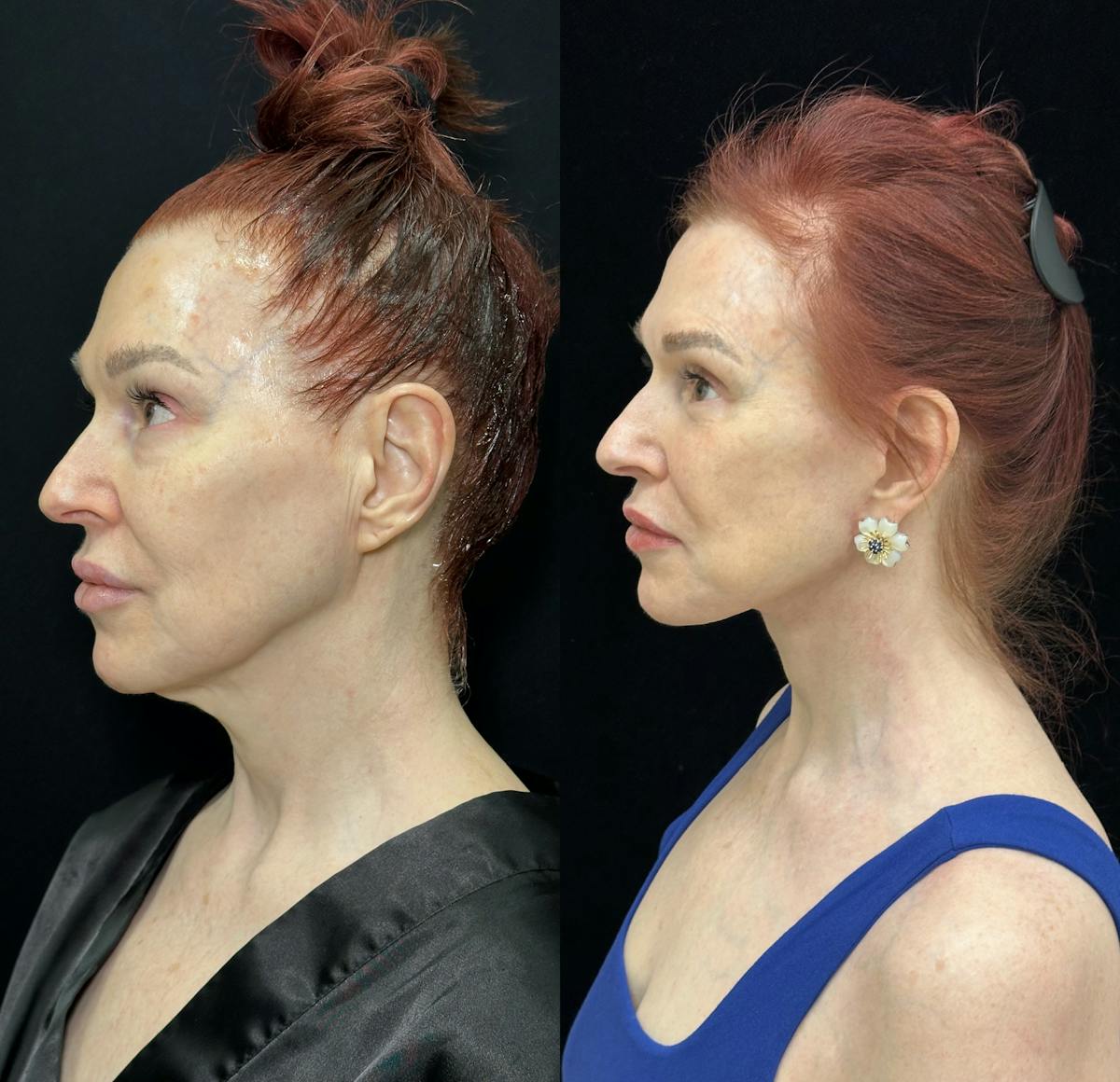 CO2 Laser Face Resurfacing Before & After Gallery - Patient 165580 - Image 6