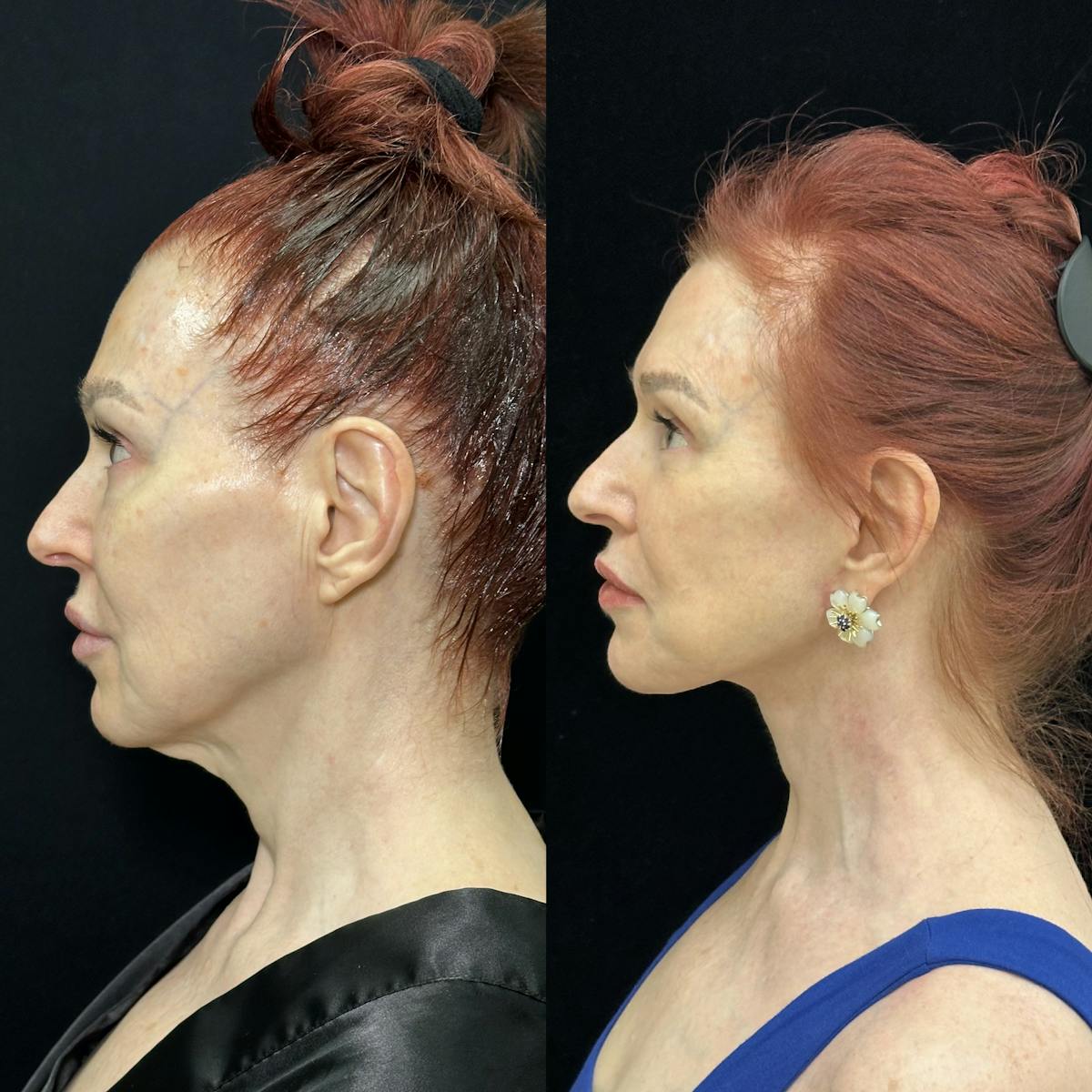 CO2 Laser Face Resurfacing Before & After Gallery - Patient 165580 - Image 5