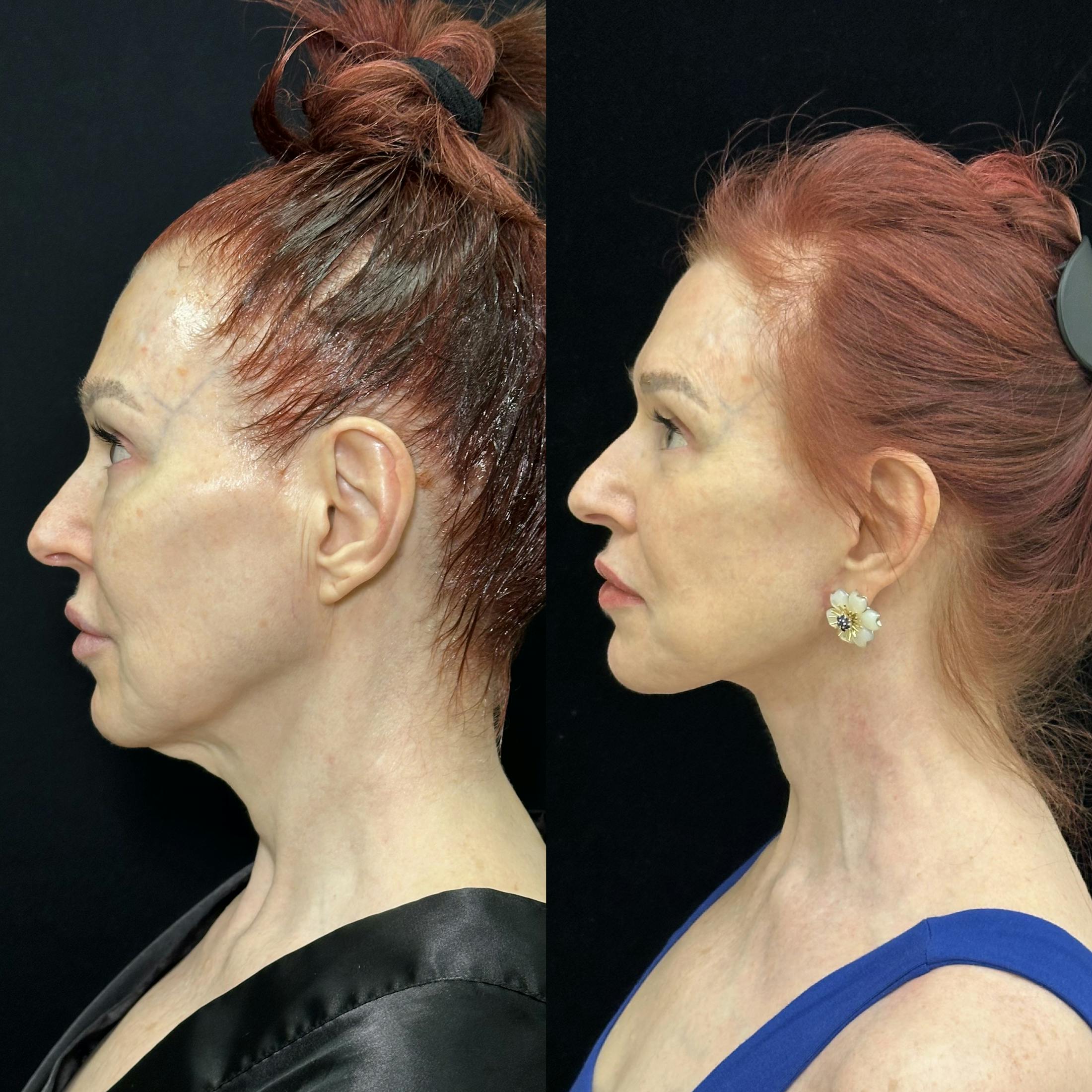 Deep Plane Facelift Before & After Gallery - Patient 123229 - Image 5