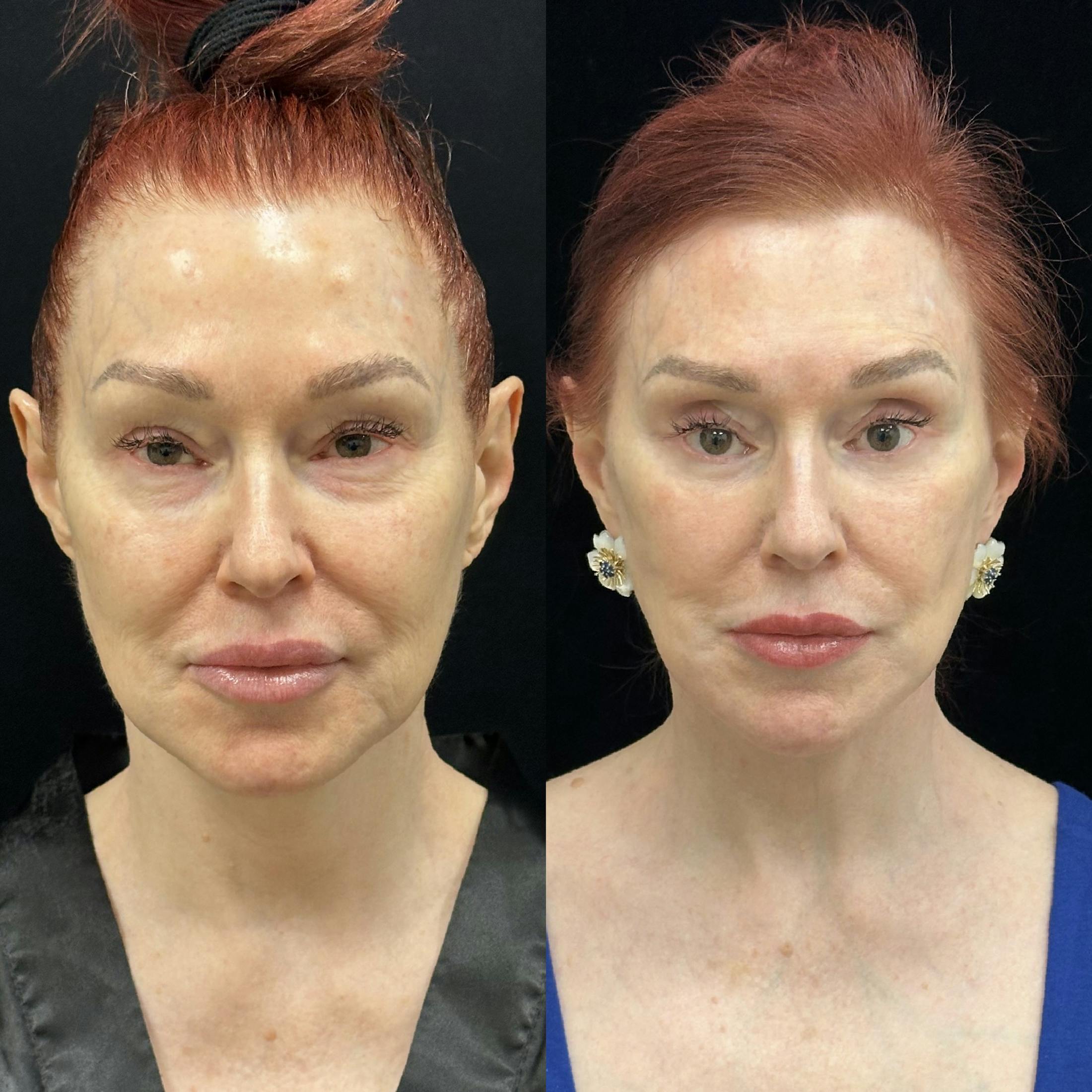 Deep Plane Facelift Before & After Gallery - Patient 123229 - Image 1