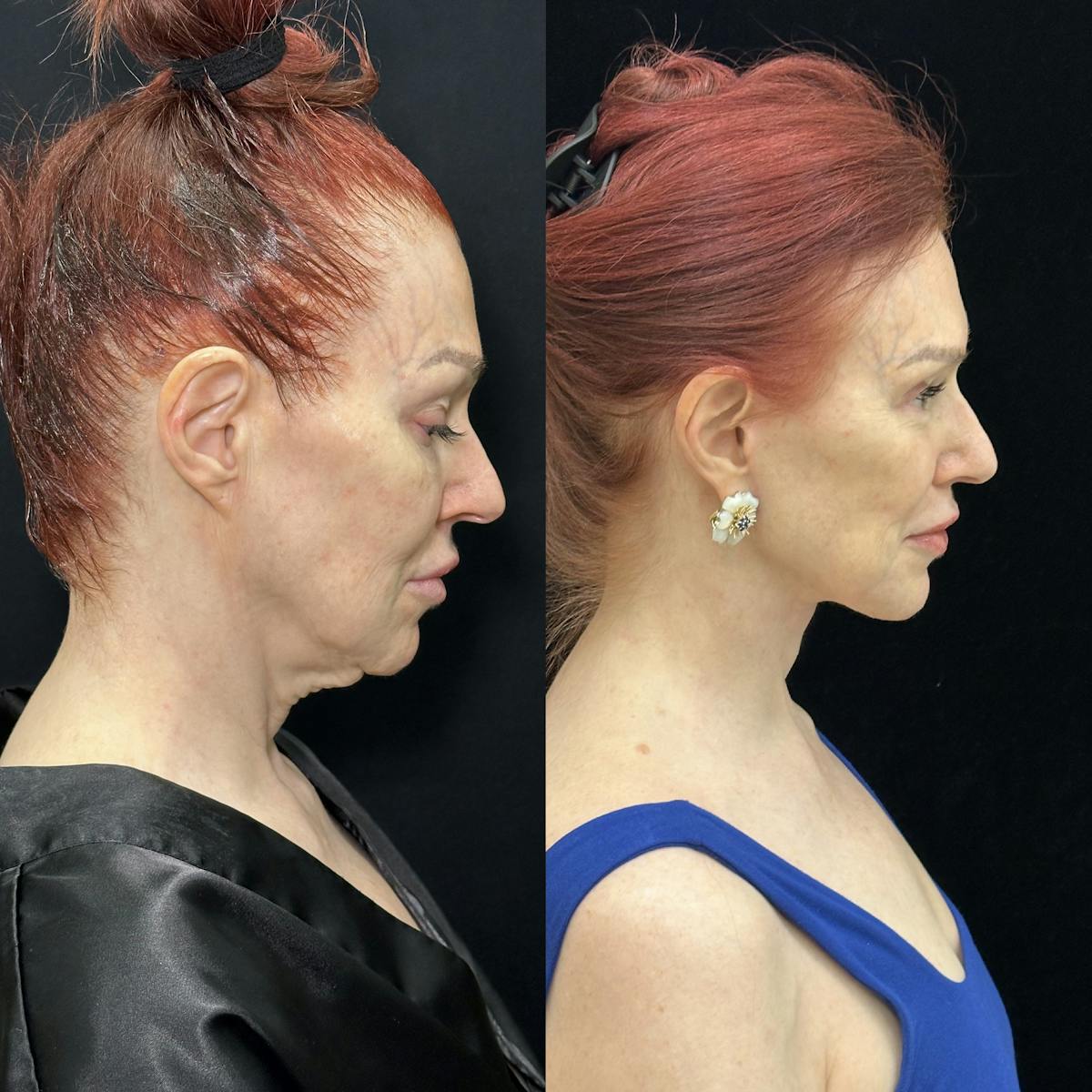 CO2 Laser Face Resurfacing Before & After Gallery - Patient 165580 - Image 4