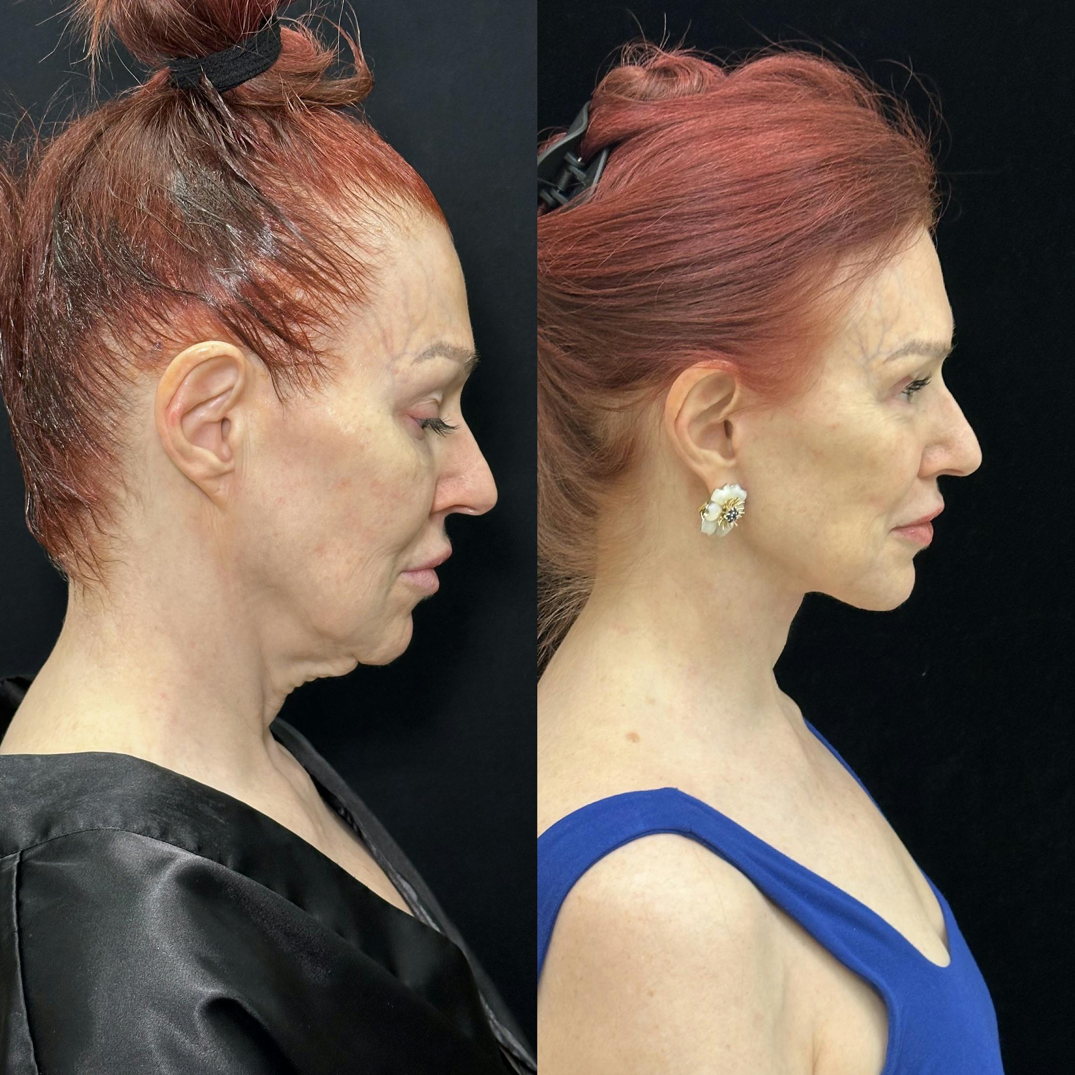 Deep Plane Facelift Before & After Gallery - Patient 123229 - Image 4