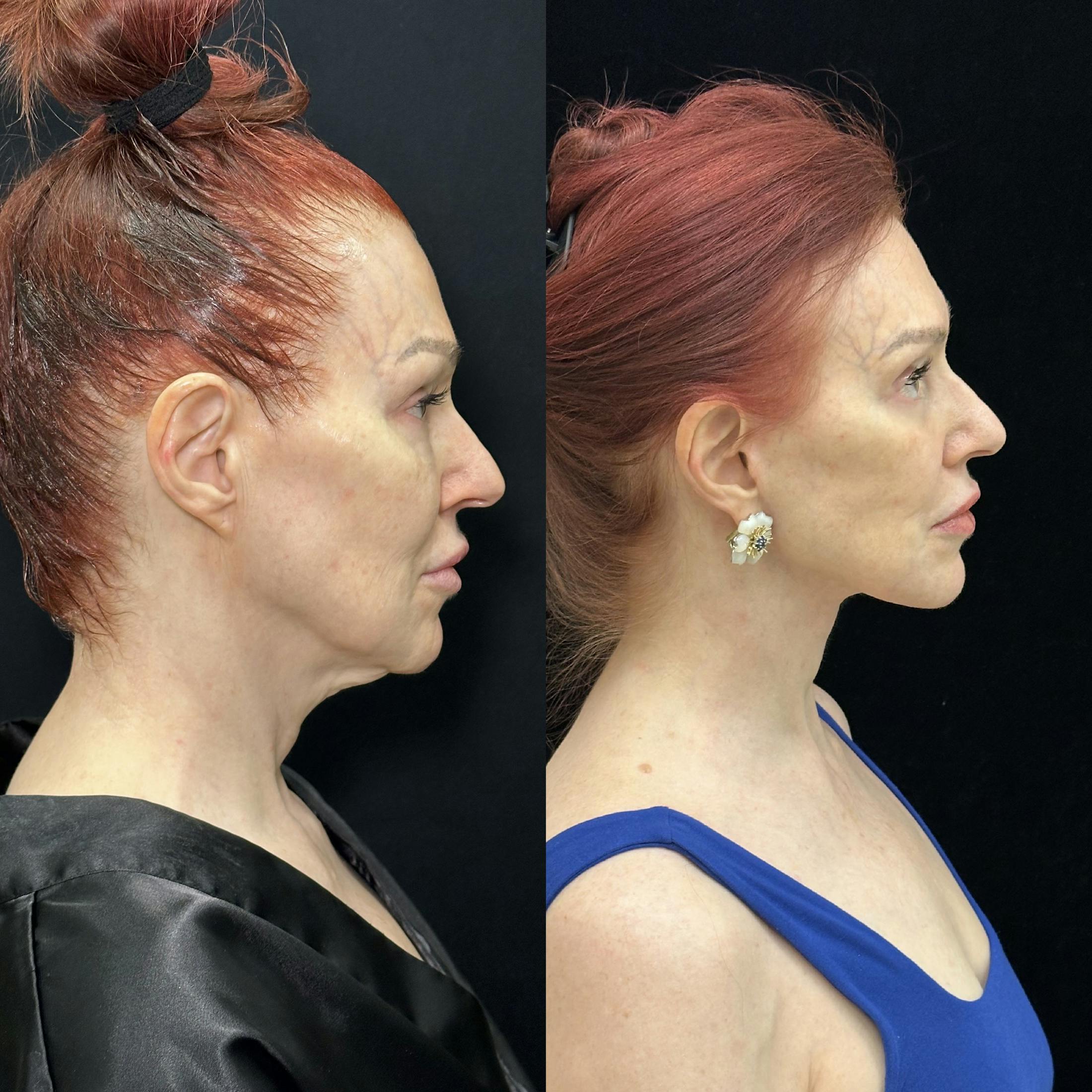 Deep Plane Facelift Before & After Gallery - Patient 123229 - Image 3