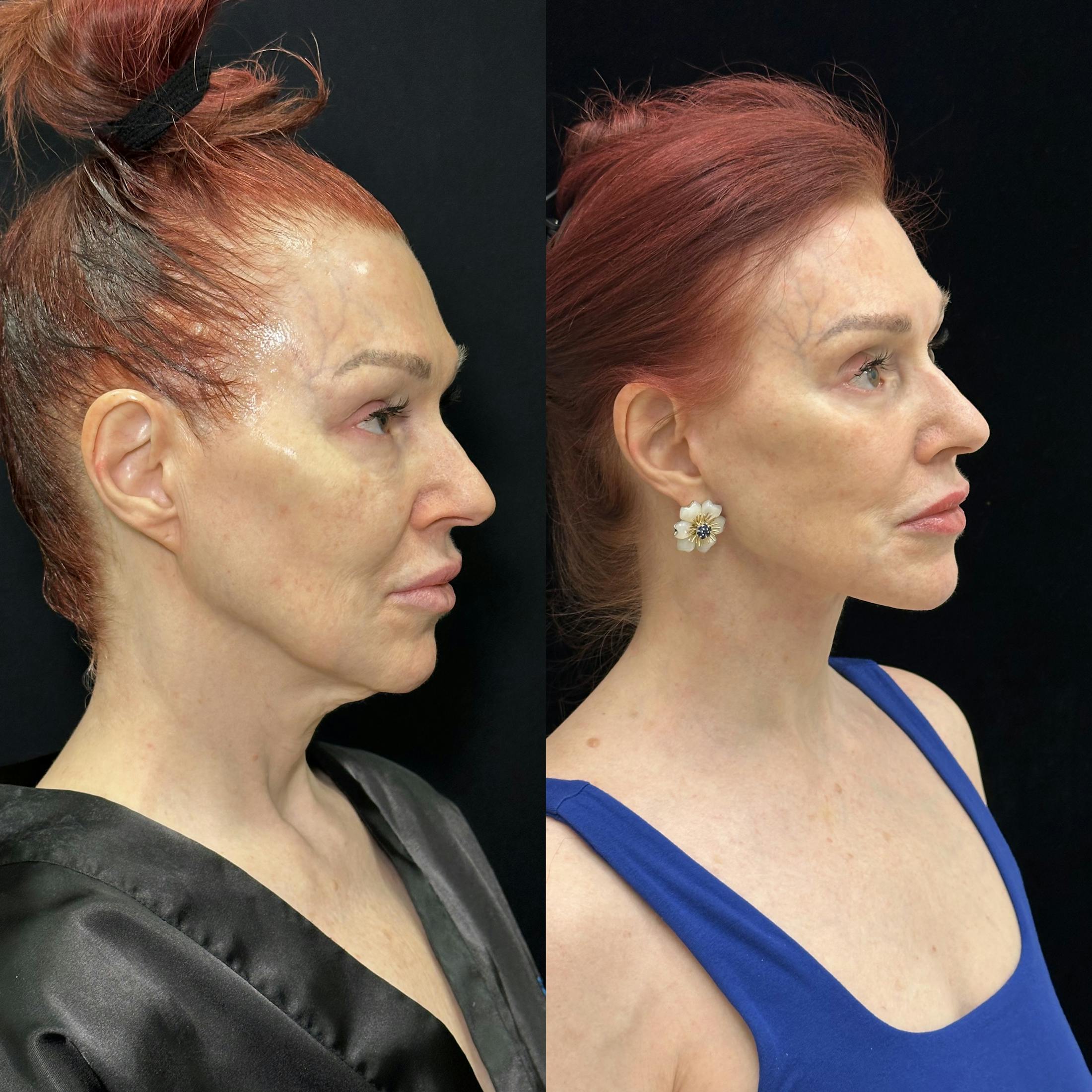 Deep Plane Facelift Before & After Gallery - Patient 123229 - Image 2