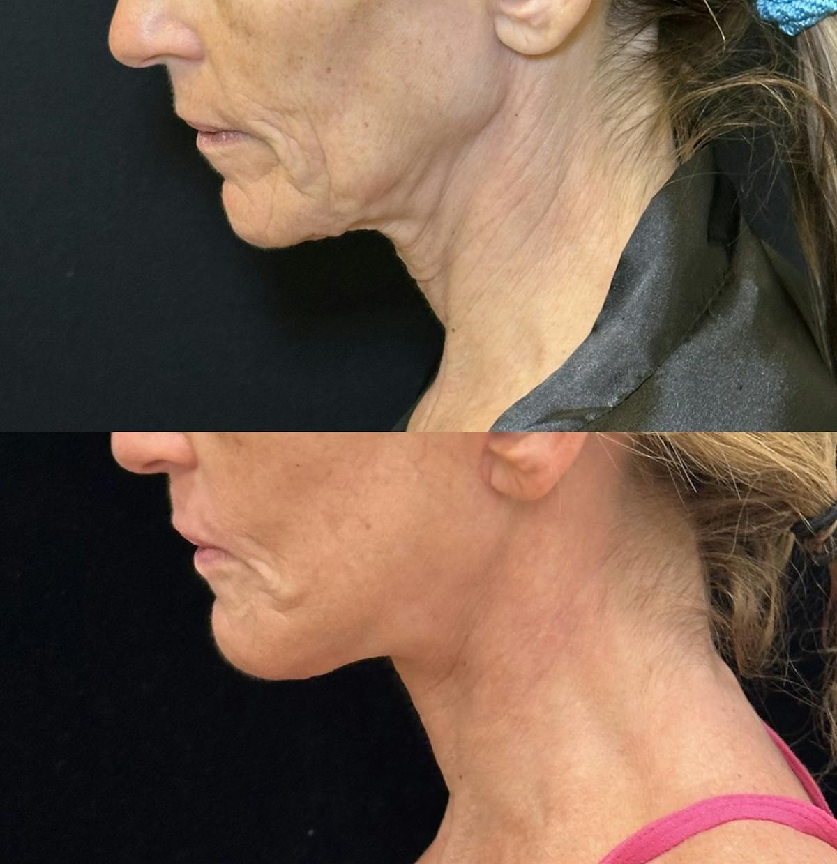 Deep Plane Facelift Before & After Gallery - Patient 328086 - Image 6