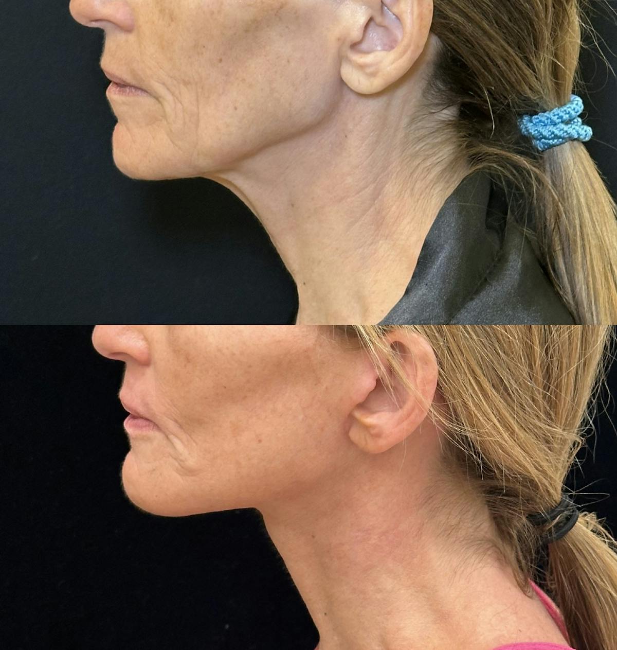 Deep Plane Facelift Before & After Gallery - Patient 328086 - Image 5