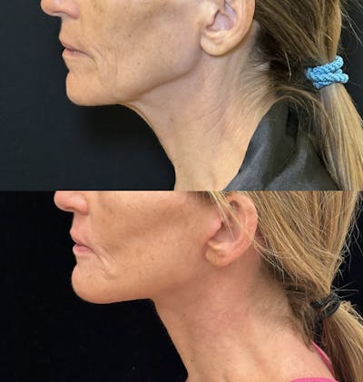 Deep Plane Facelift Before & After Gallery - Patient 328086 - Image 5