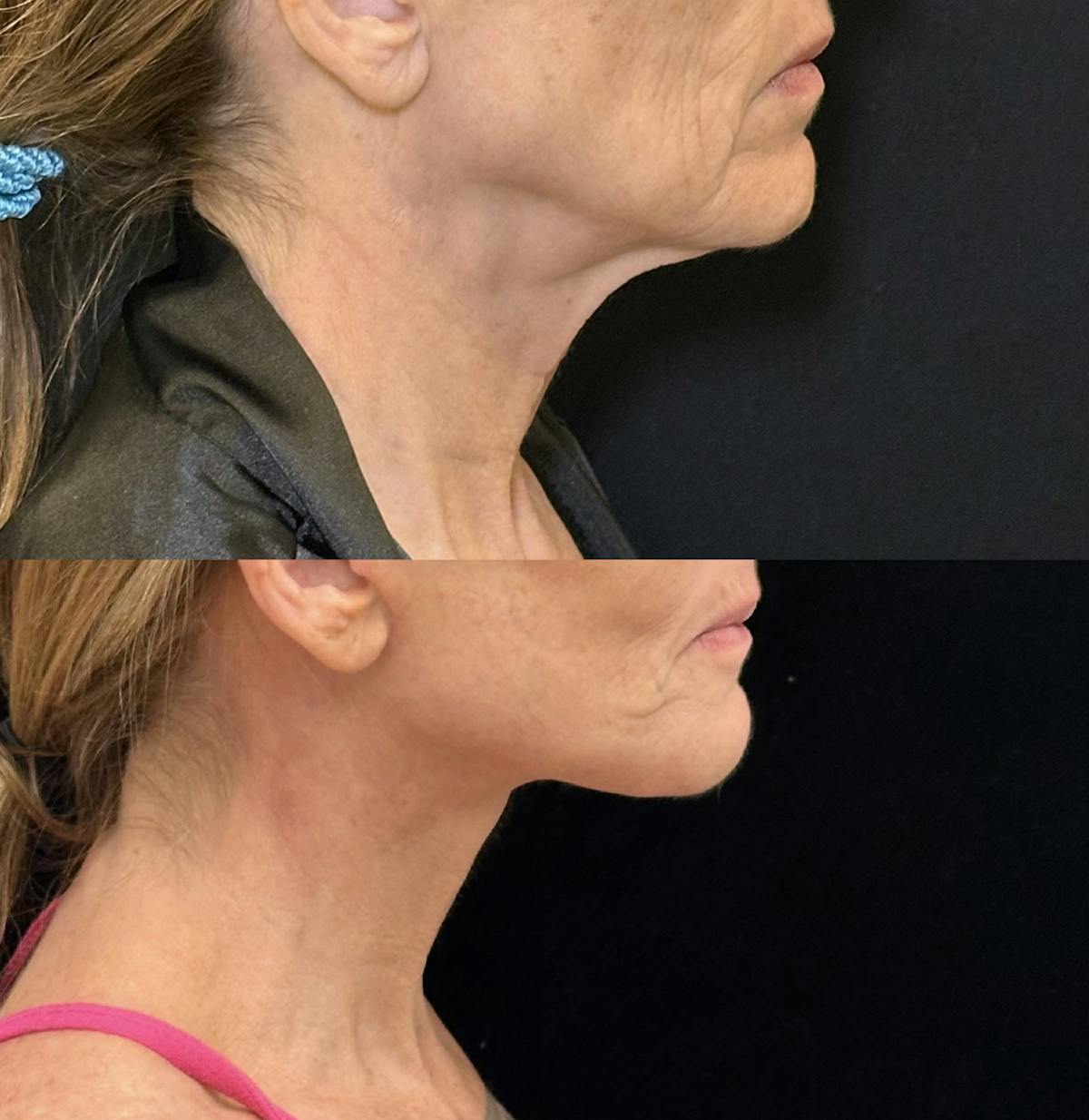Deep Plane Facelift Before & After Gallery - Patient 328086 - Image 2