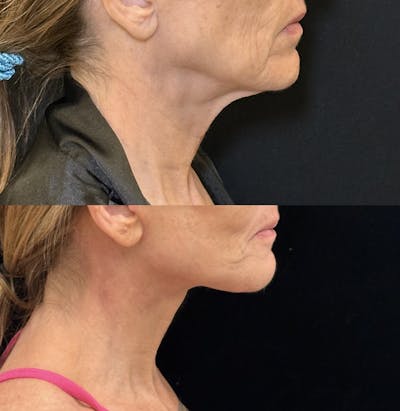 Deep Plane Facelift Before & After Gallery - Patient 328086 - Image 2