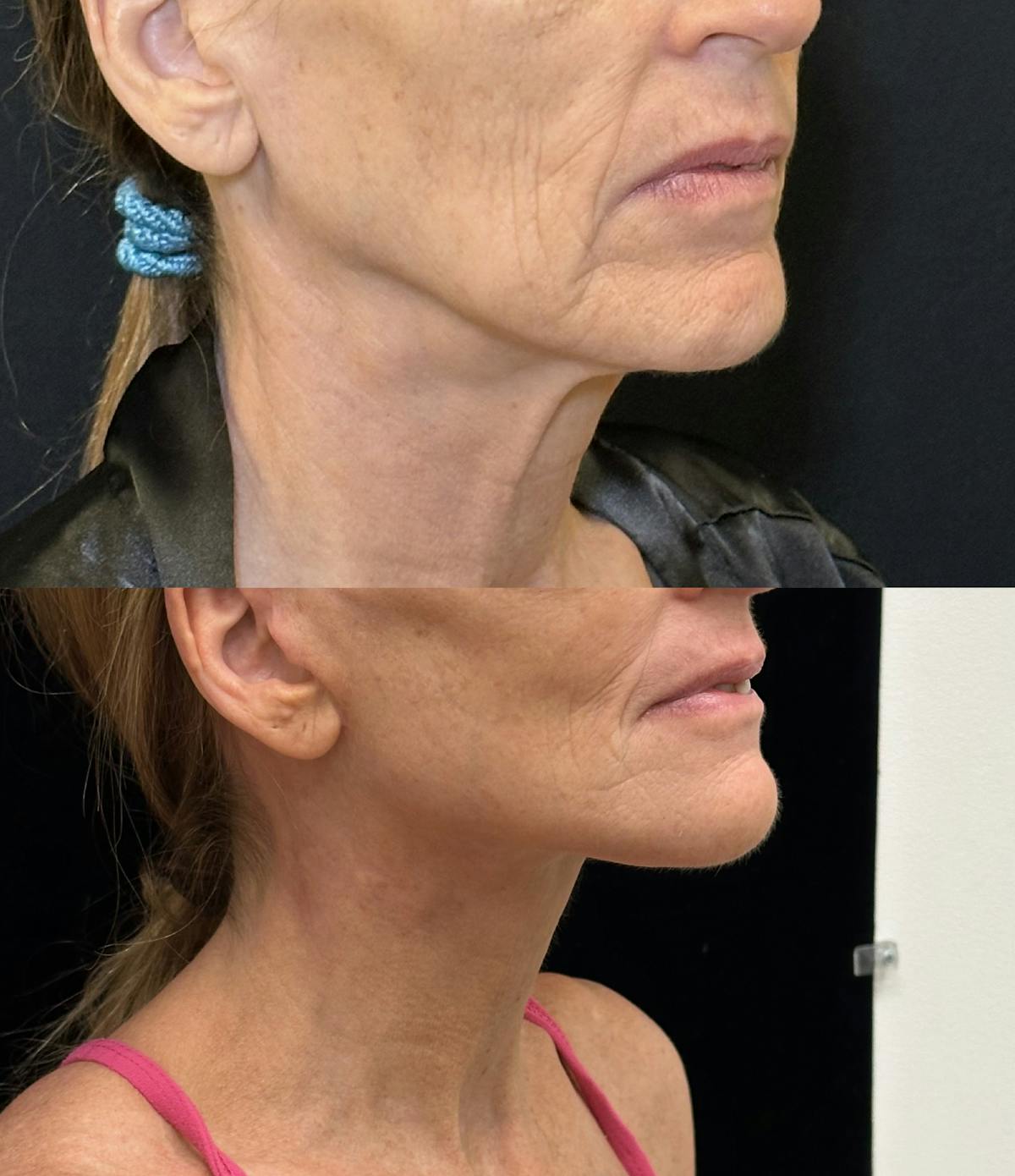 Deep Plane Facelift Before & After Gallery - Patient 328086 - Image 1