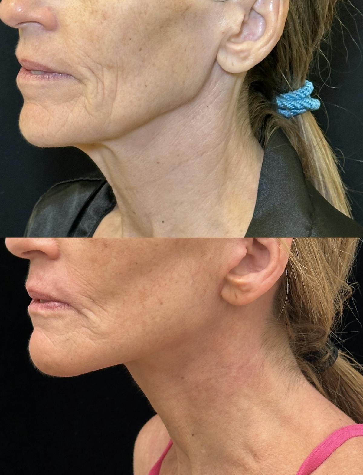 Deep Plane Facelift Before & After Gallery - Patient 328086 - Image 4