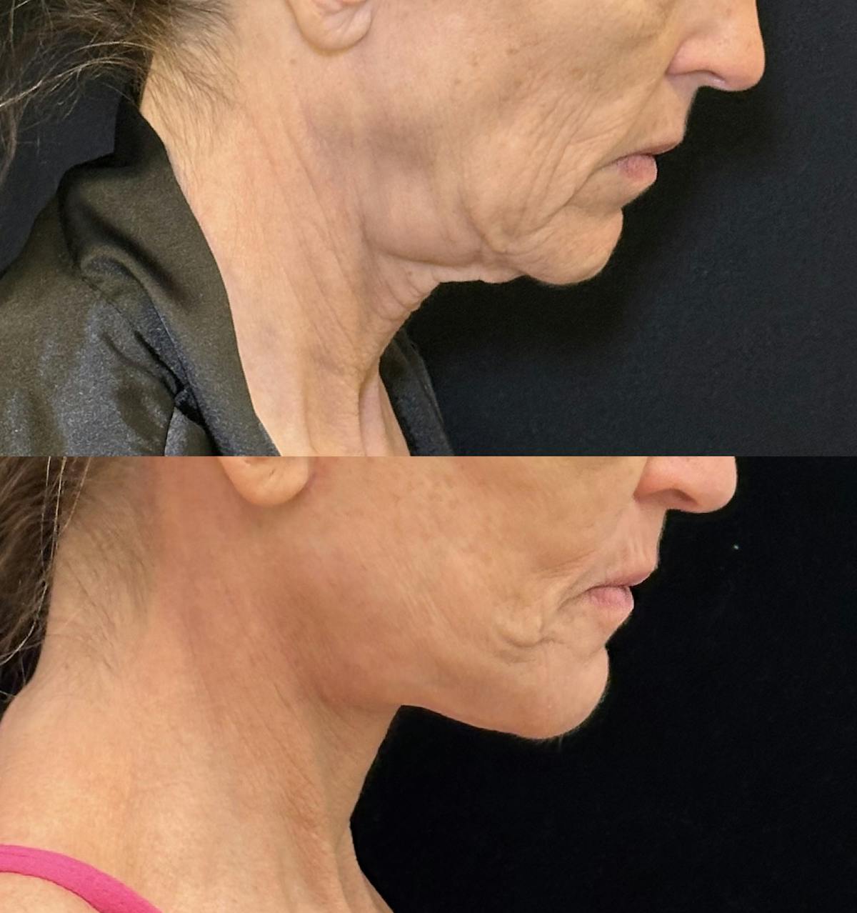 Deep Plane Facelift Before & After Gallery - Patient 328086 - Image 3
