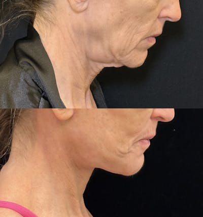 Deep Plane Facelift Before & After Gallery - Patient 328086 - Image 3