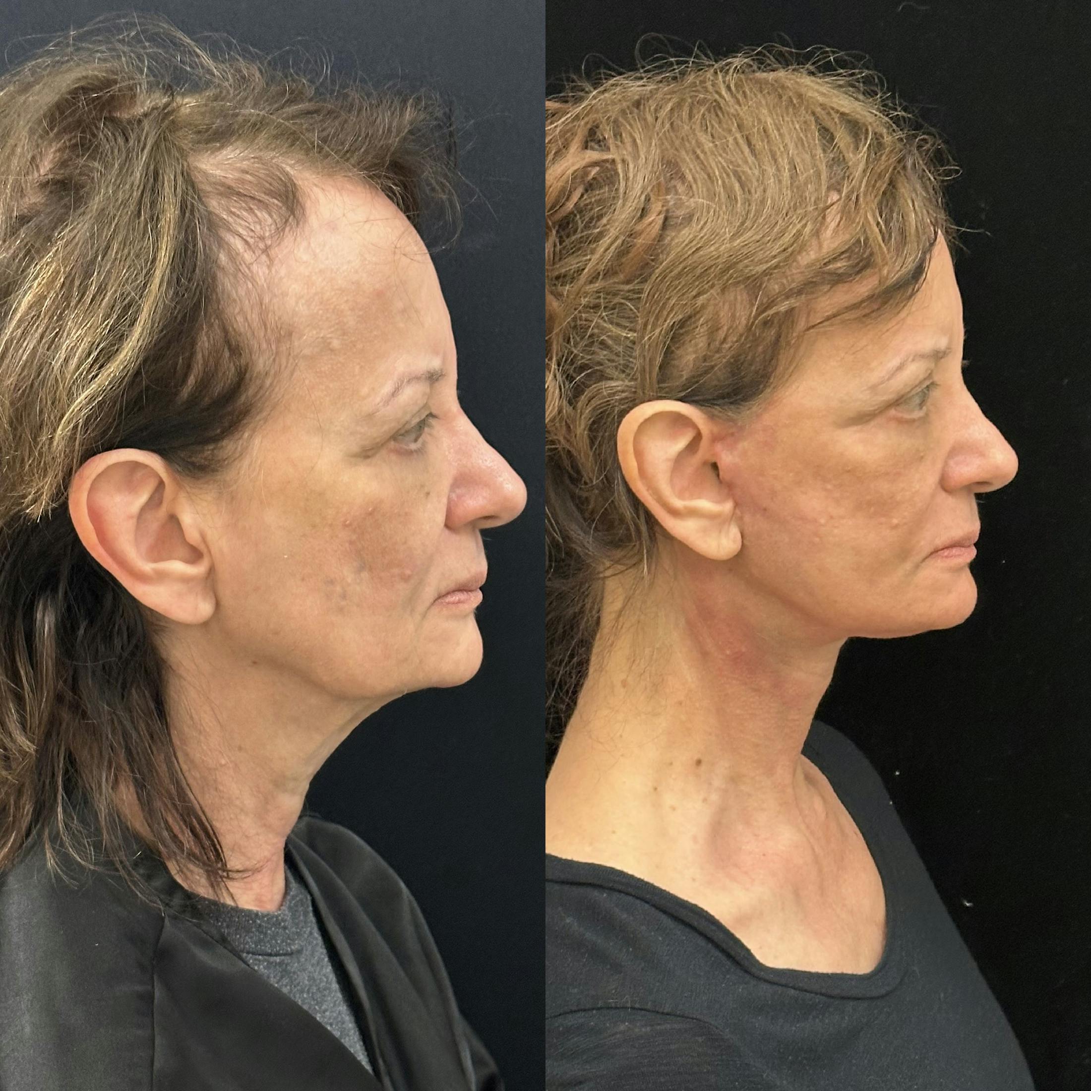 Deep Plane Facelift Before & After Gallery - Patient 347065 - Image 3
