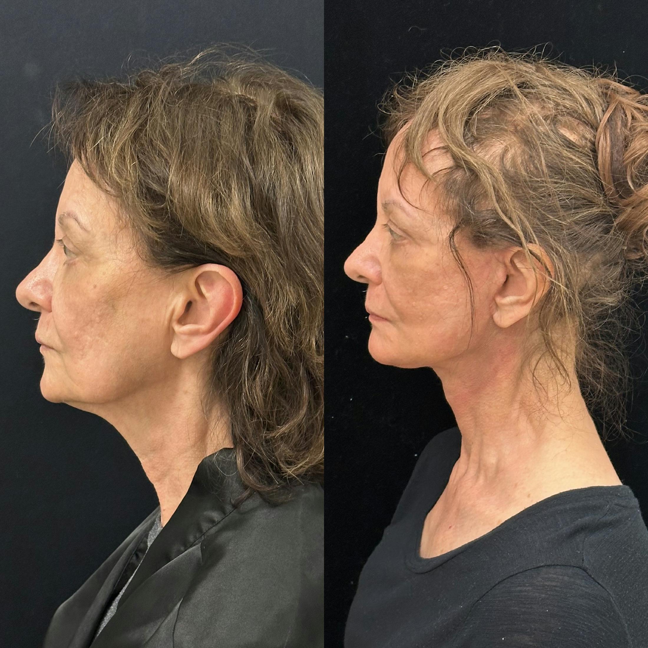 Deep Plane Facelift Before & After Gallery - Patient 347065 - Image 5