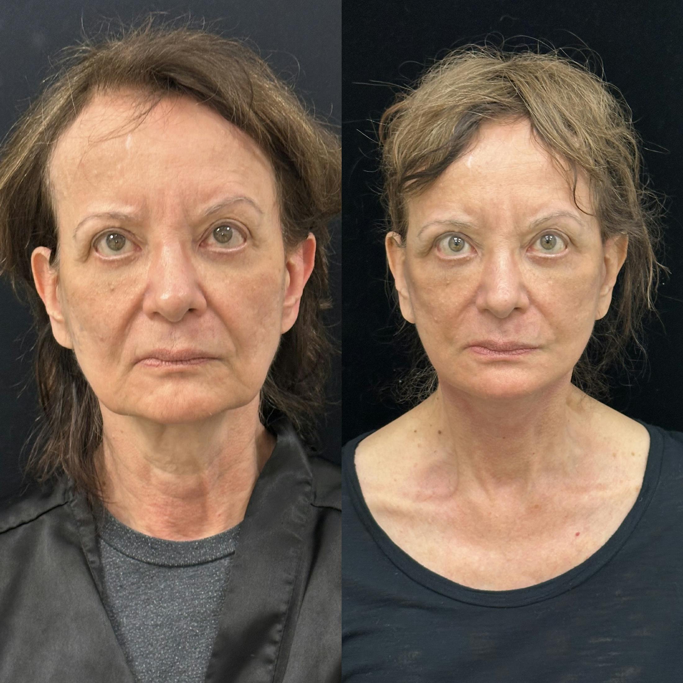 Deep Plane Facelift Before & After Gallery - Patient 347065 - Image 1