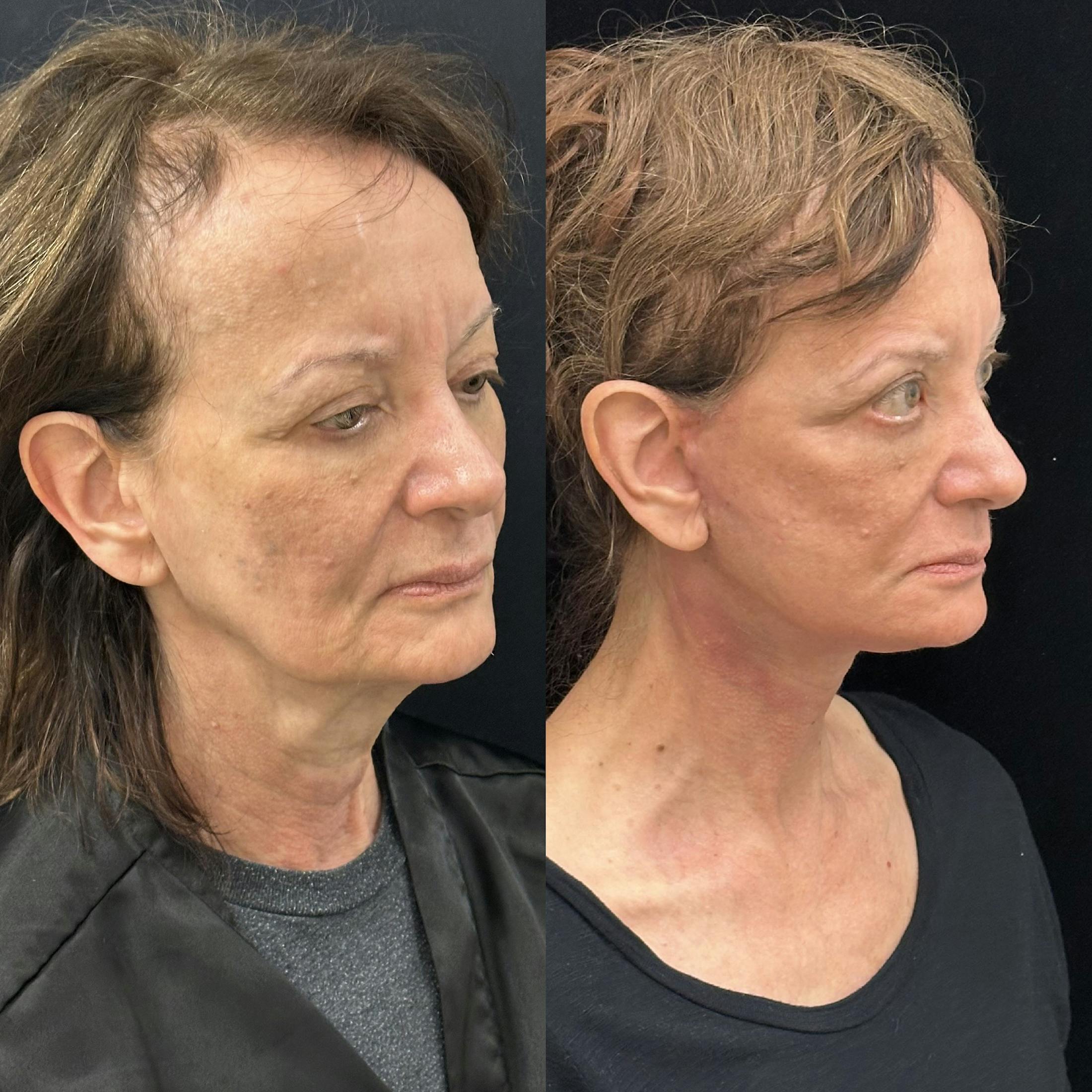 Deep Plane Facelift Before & After Gallery - Patient 347065 - Image 2