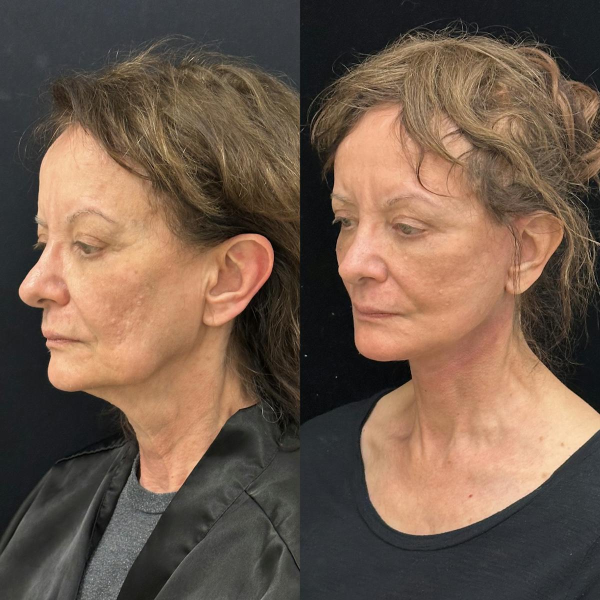 Necklift Before & After Gallery - Patient 200787 - Image 4