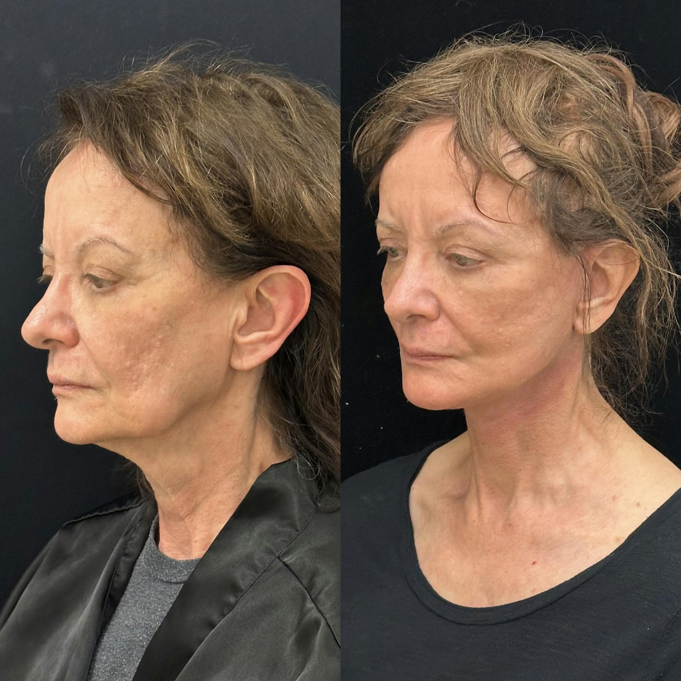 Deep Plane Facelift Before & After Gallery - Patient 347065 - Image 4