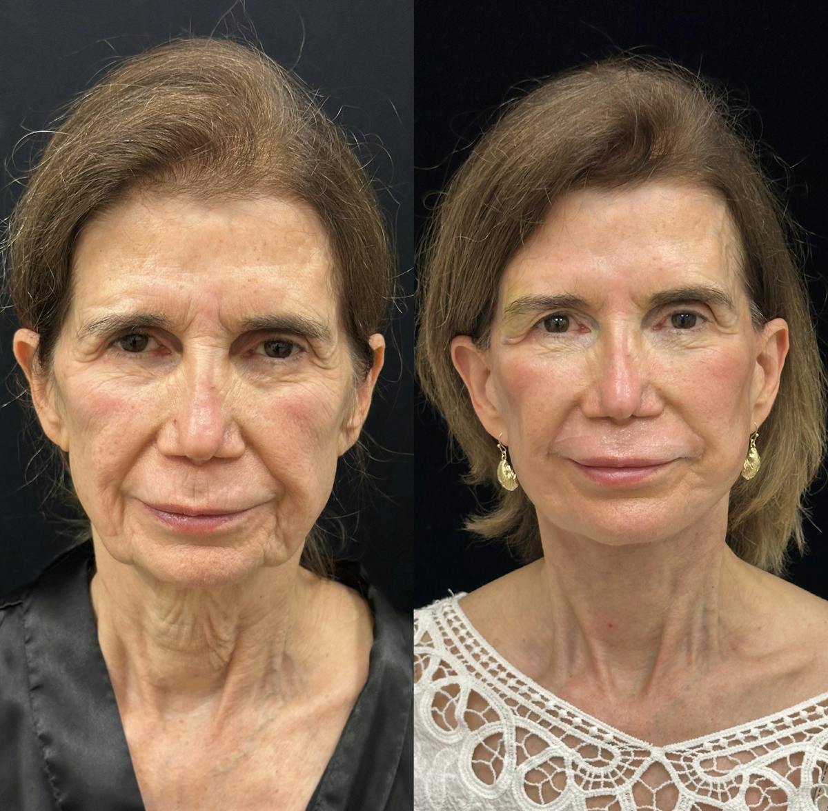 CO2 Laser Face Resurfacing Before & After Gallery - Patient 538335 - Image 1