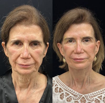 Deep Plane Facelift Before & After Gallery - Patient 260224 - Image 1