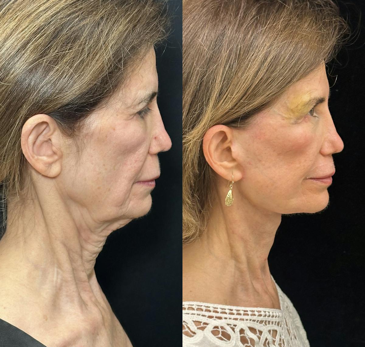 CO2 Laser Face Resurfacing Before & After Gallery - Patient 538335 - Image 3