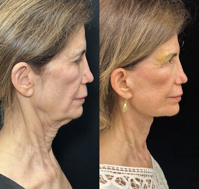 Deep Plane Facelift Before & After Gallery - Patient 260224 - Image 3