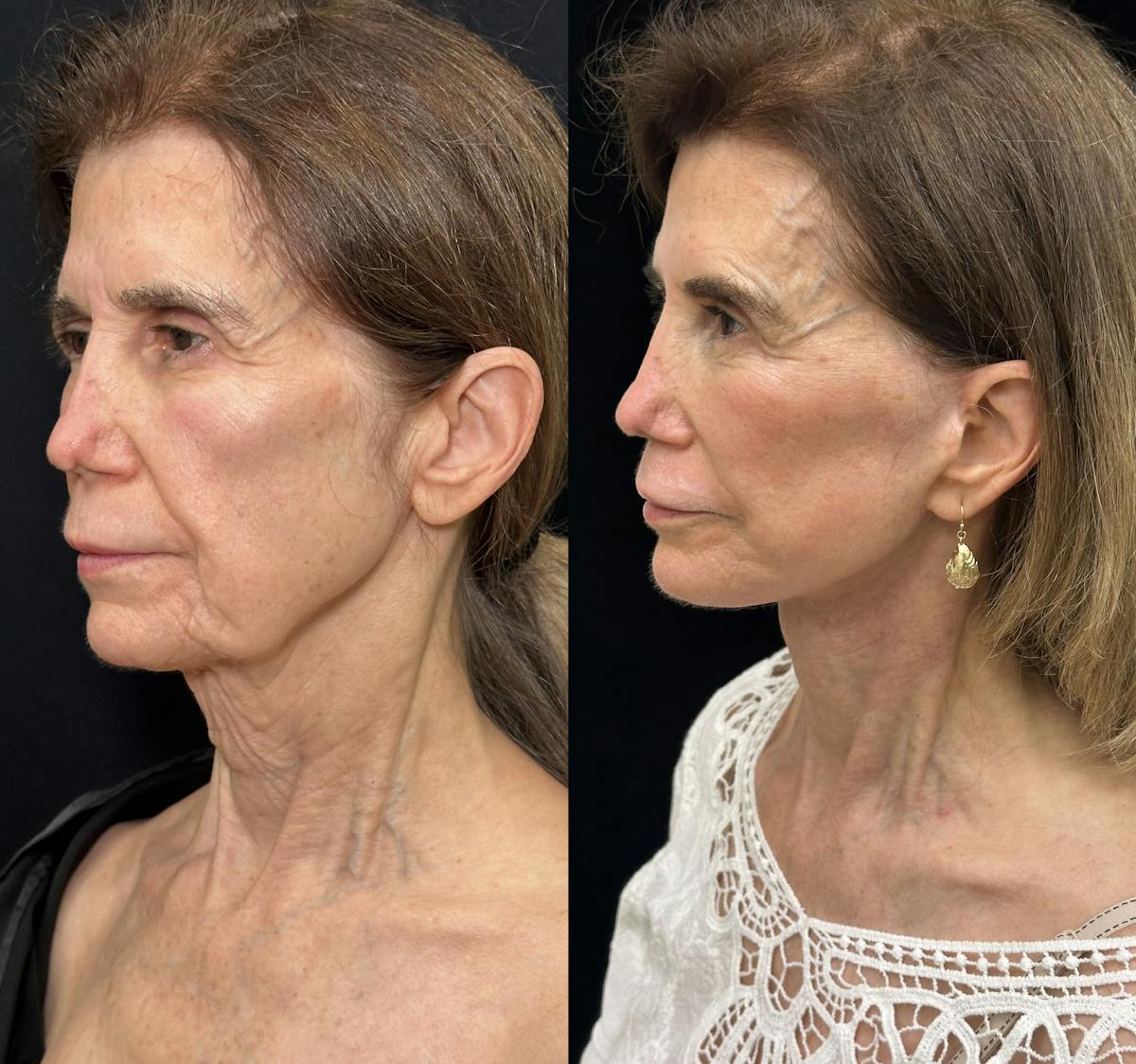 CO2 Laser Face Resurfacing Before & After Gallery - Patient 538335 - Image 4