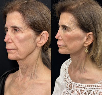 Deep Plane Facelift Before & After Gallery - Patient 260224 - Image 4