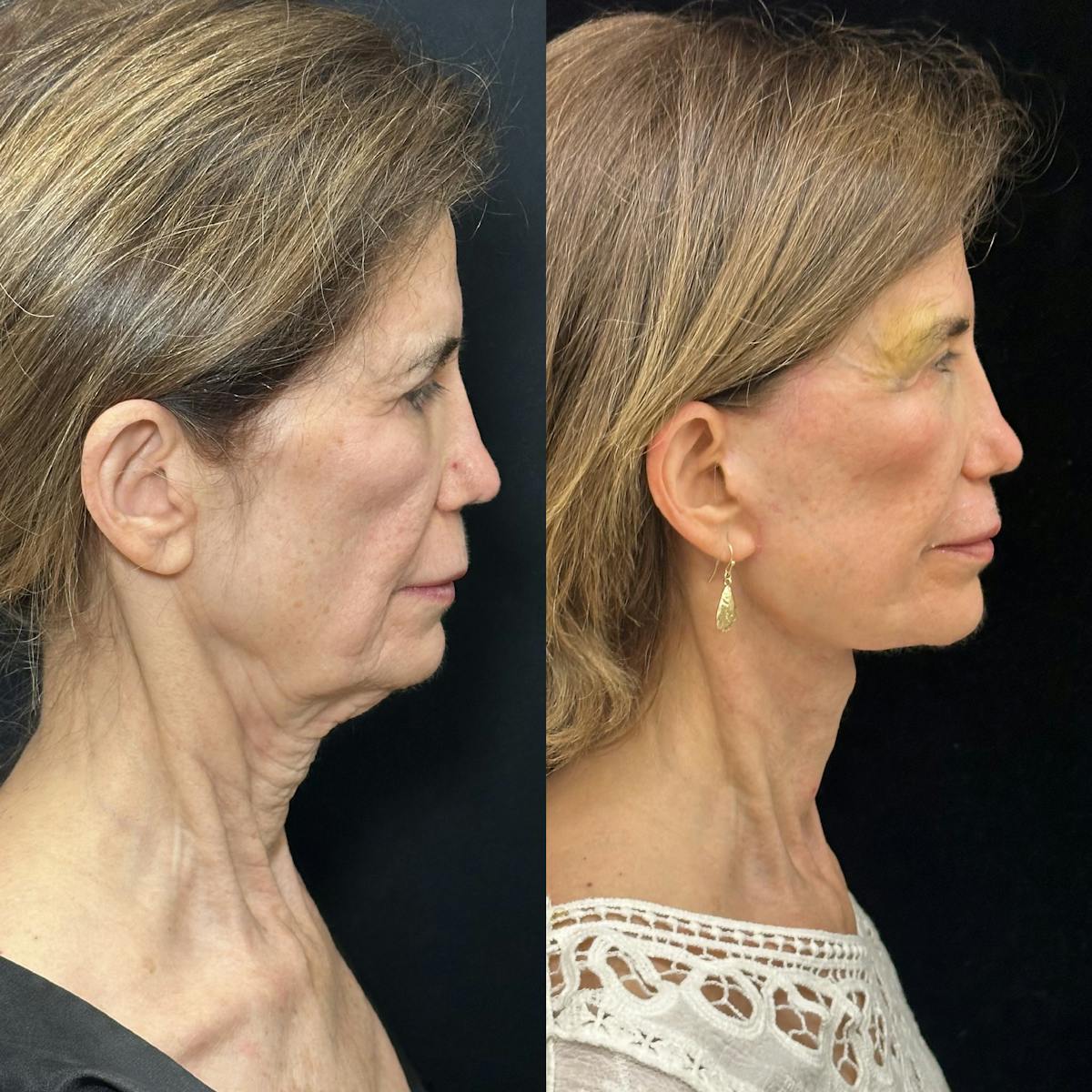 CO2 Laser Face Resurfacing Before & After Gallery - Patient 538335 - Image 2
