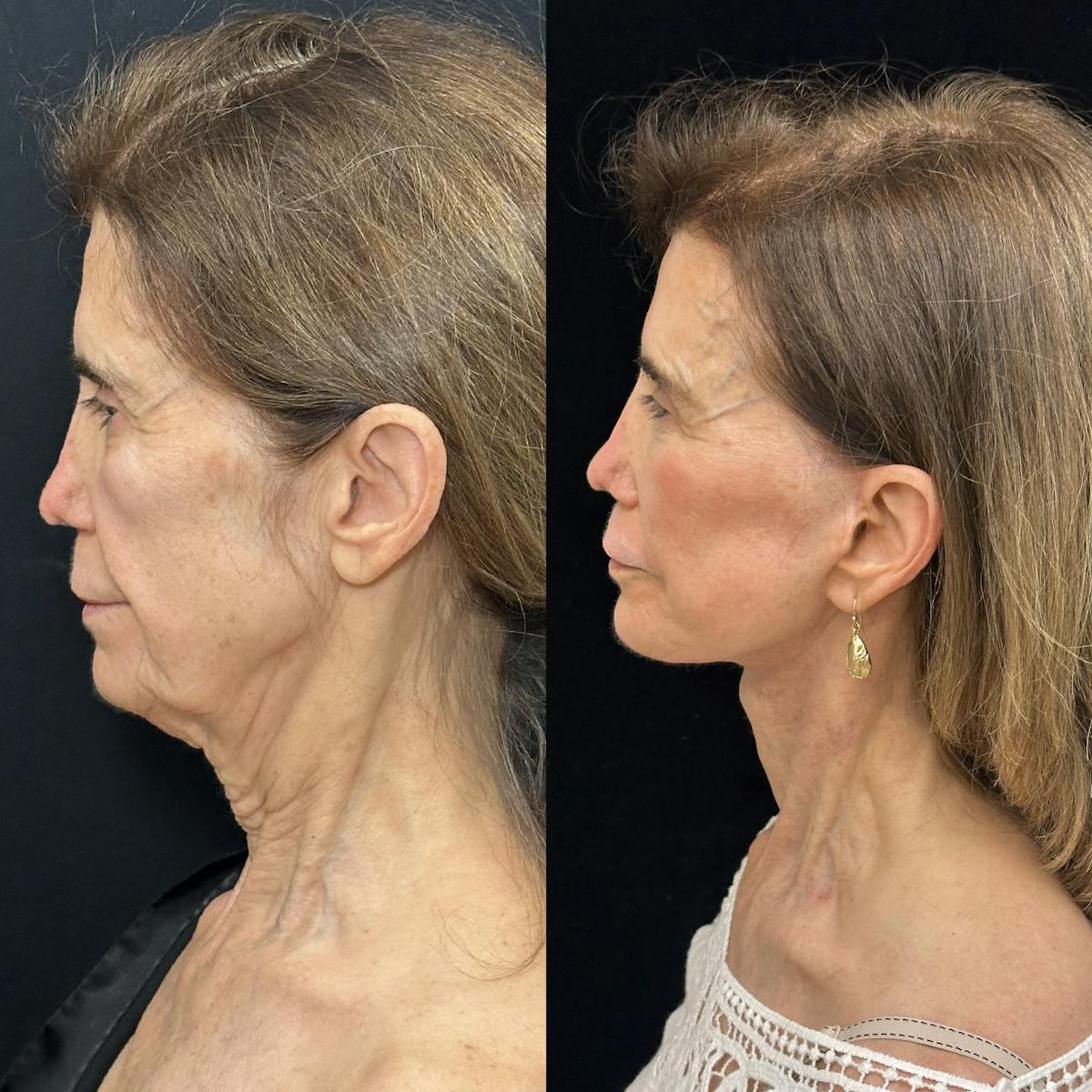 CO2 Laser Face Resurfacing Before & After Gallery - Patient 538335 - Image 5