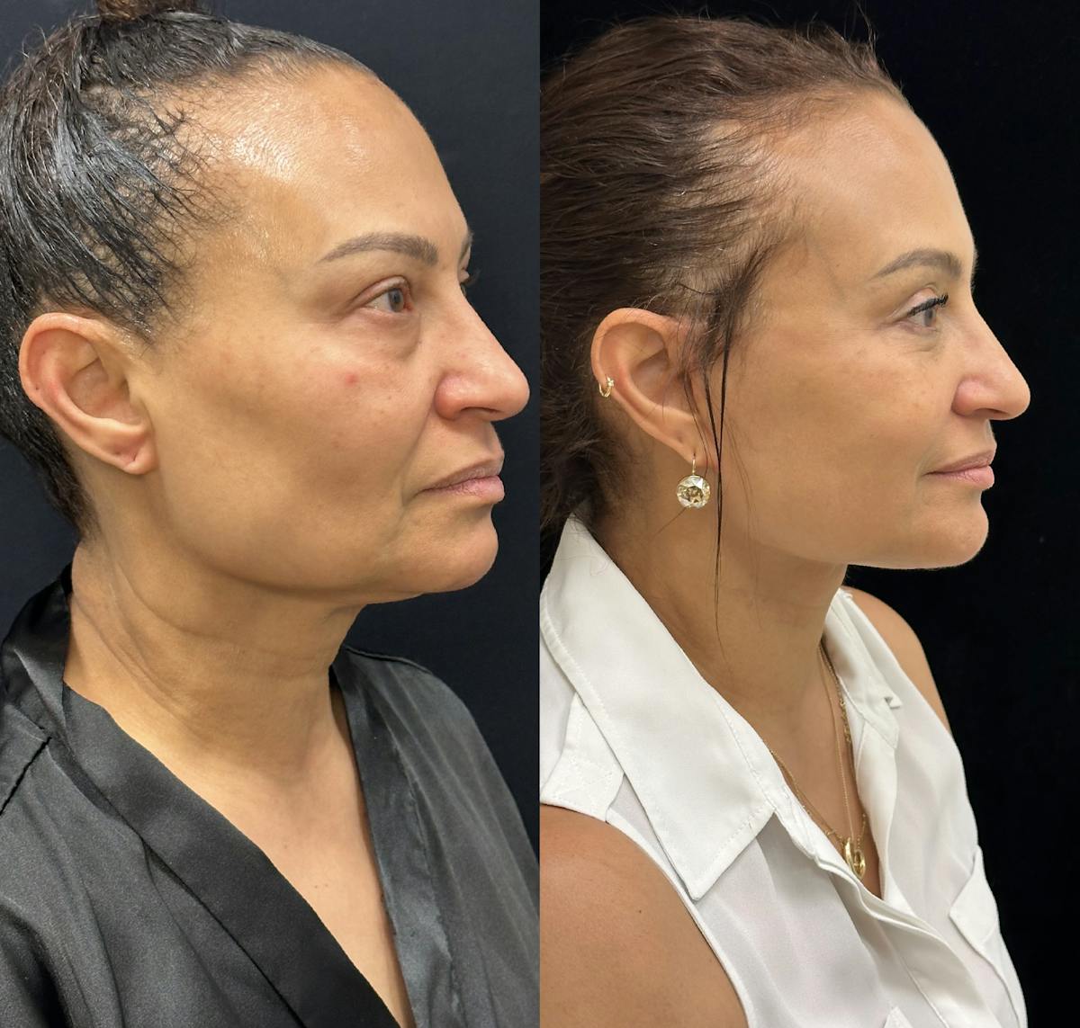 Deep Plane Facelift Before & After Gallery - Patient 232326 - Image 1