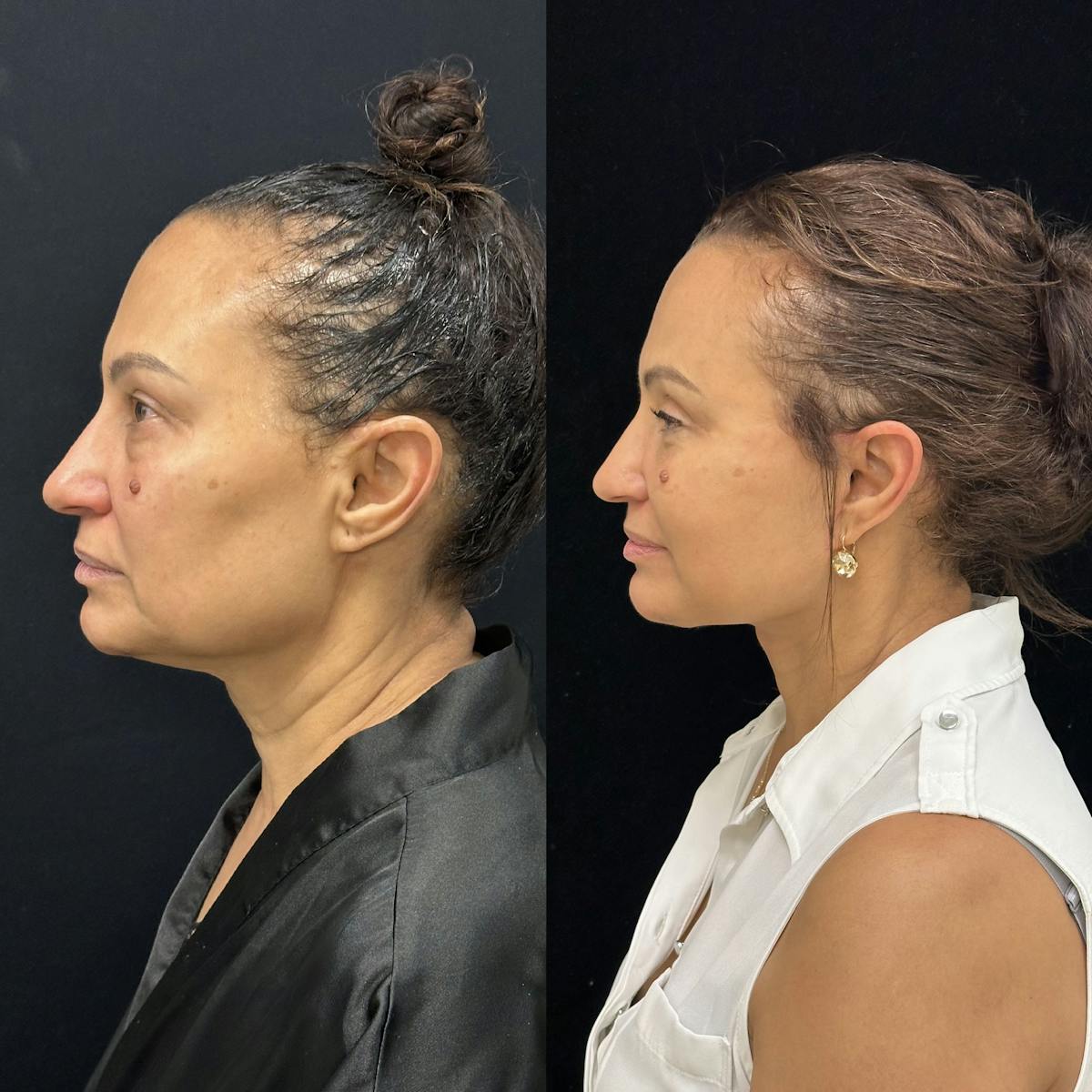 Deep Plane Facelift Before & After Gallery - Patient 232326 - Image 5