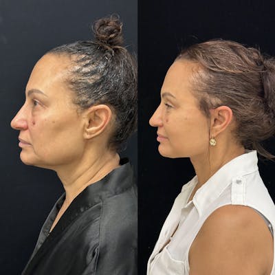 Deep Plane Facelift Before & After Gallery - Patient 232326 - Image 5