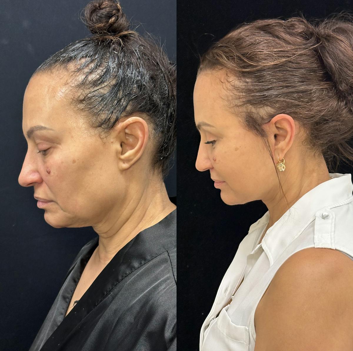 Deep Plane Facelift Before & After Gallery - Patient 232326 - Image 6