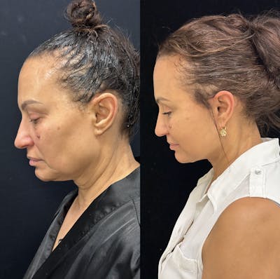 Deep Plane Facelift Before & After Gallery - Patient 232326 - Image 6