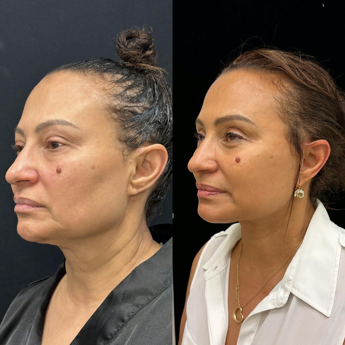 Deep Plane Facelift Before & After Gallery - Patient 232326 - Image 4