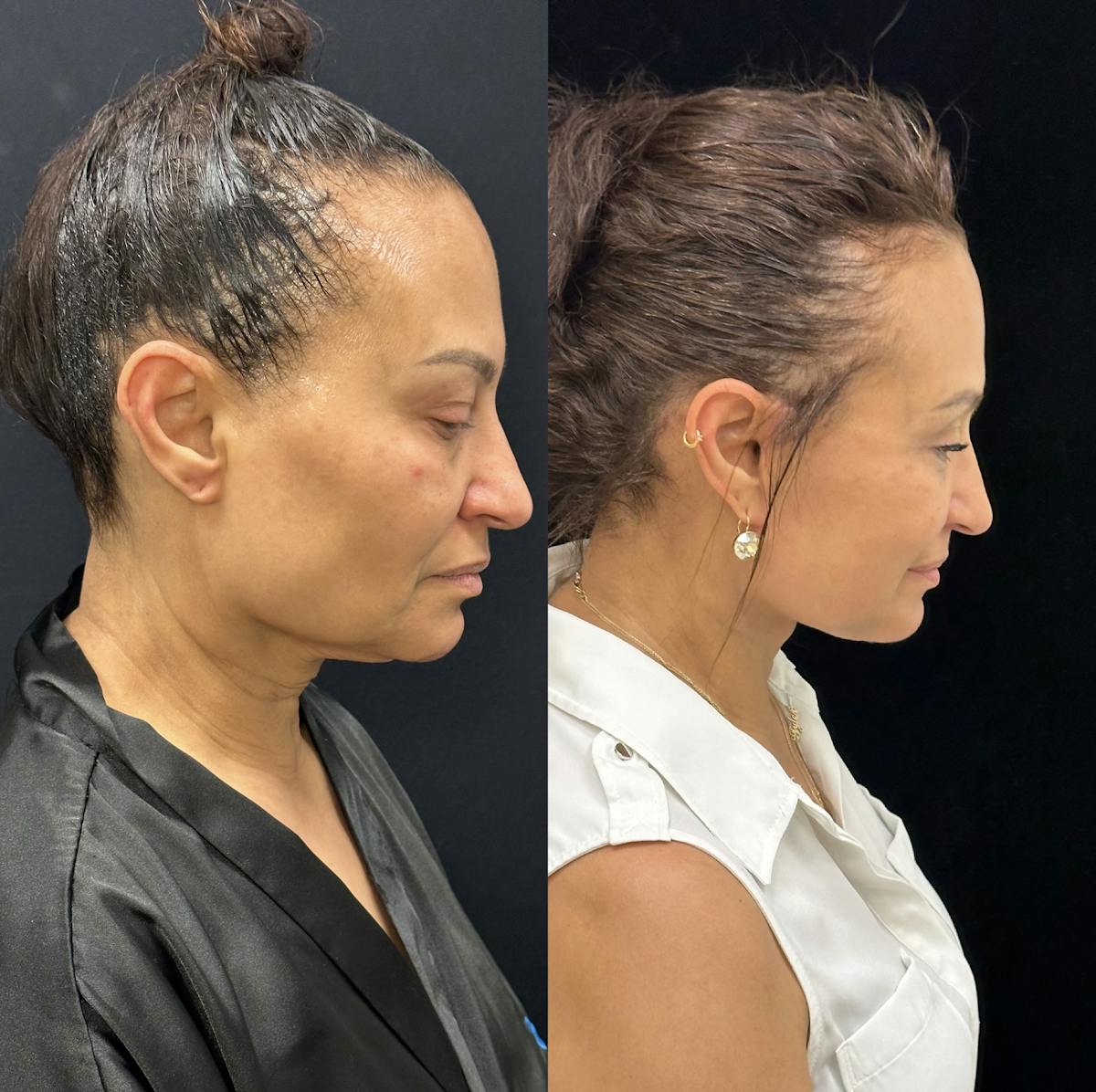 Deep Plane Facelift Before & After Gallery - Patient 232326 - Image 3