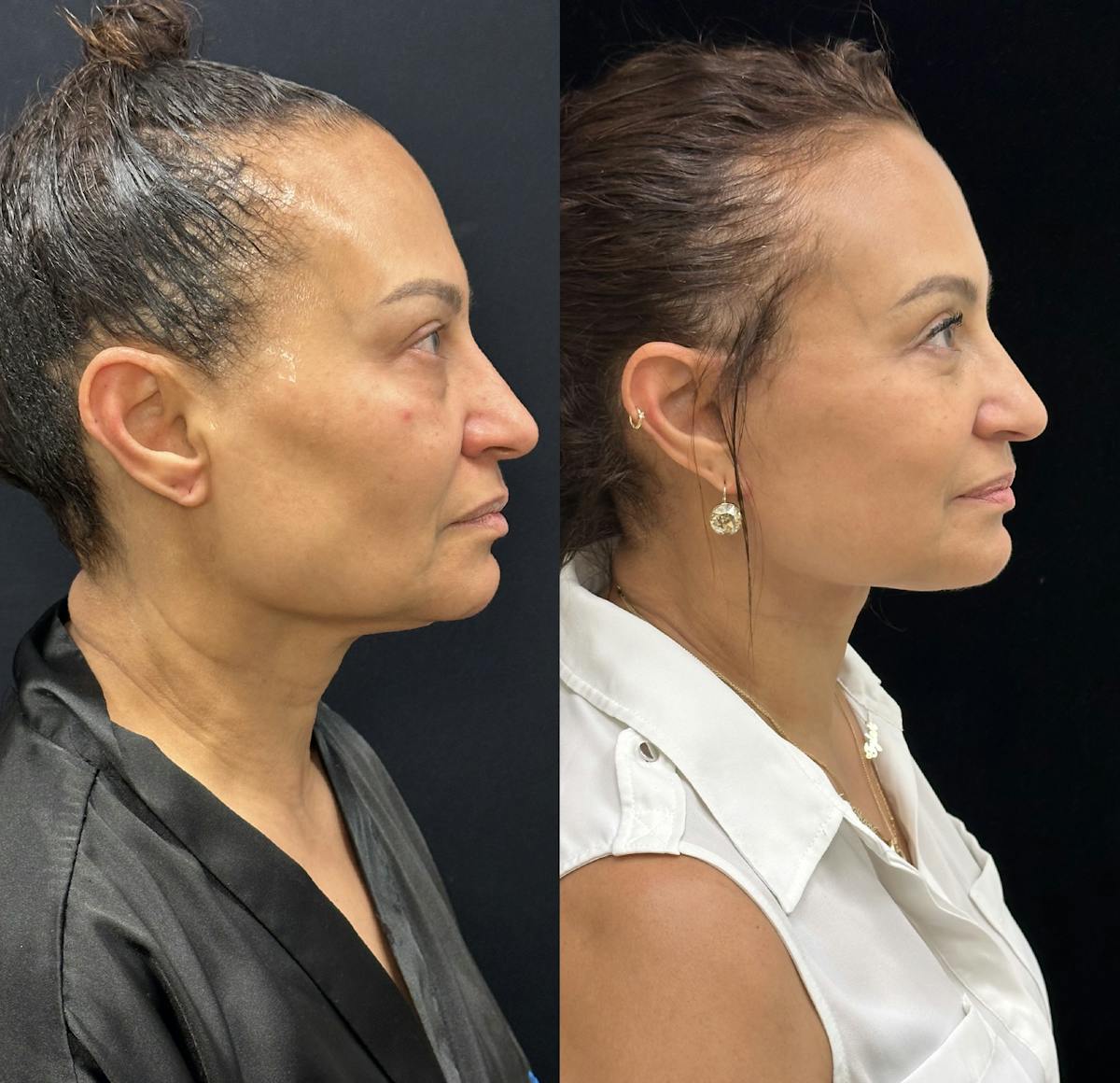 Deep Plane Facelift Before & After Gallery - Patient 232326 - Image 2