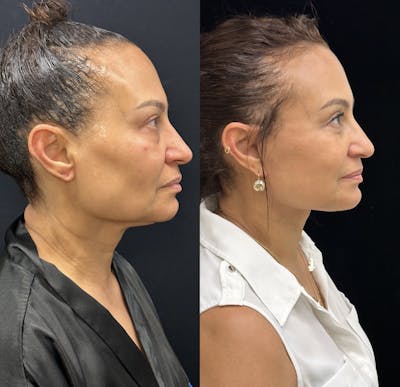 Deep Plane Facelift Before & After Gallery - Patient 232326 - Image 2