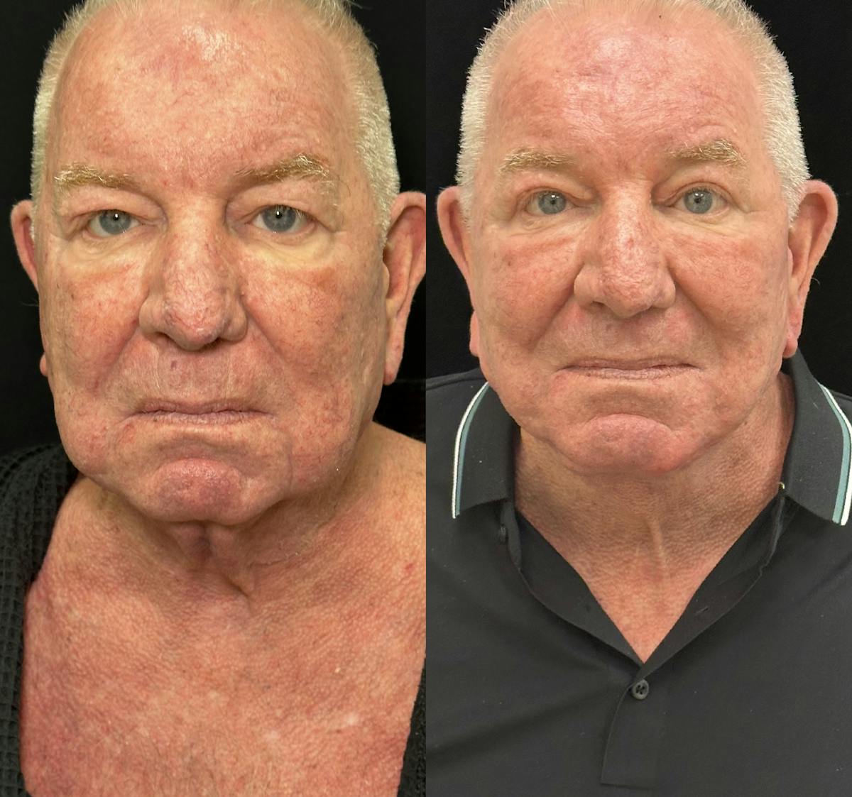 Necklift Before & After Gallery - Patient 109215 - Image 1